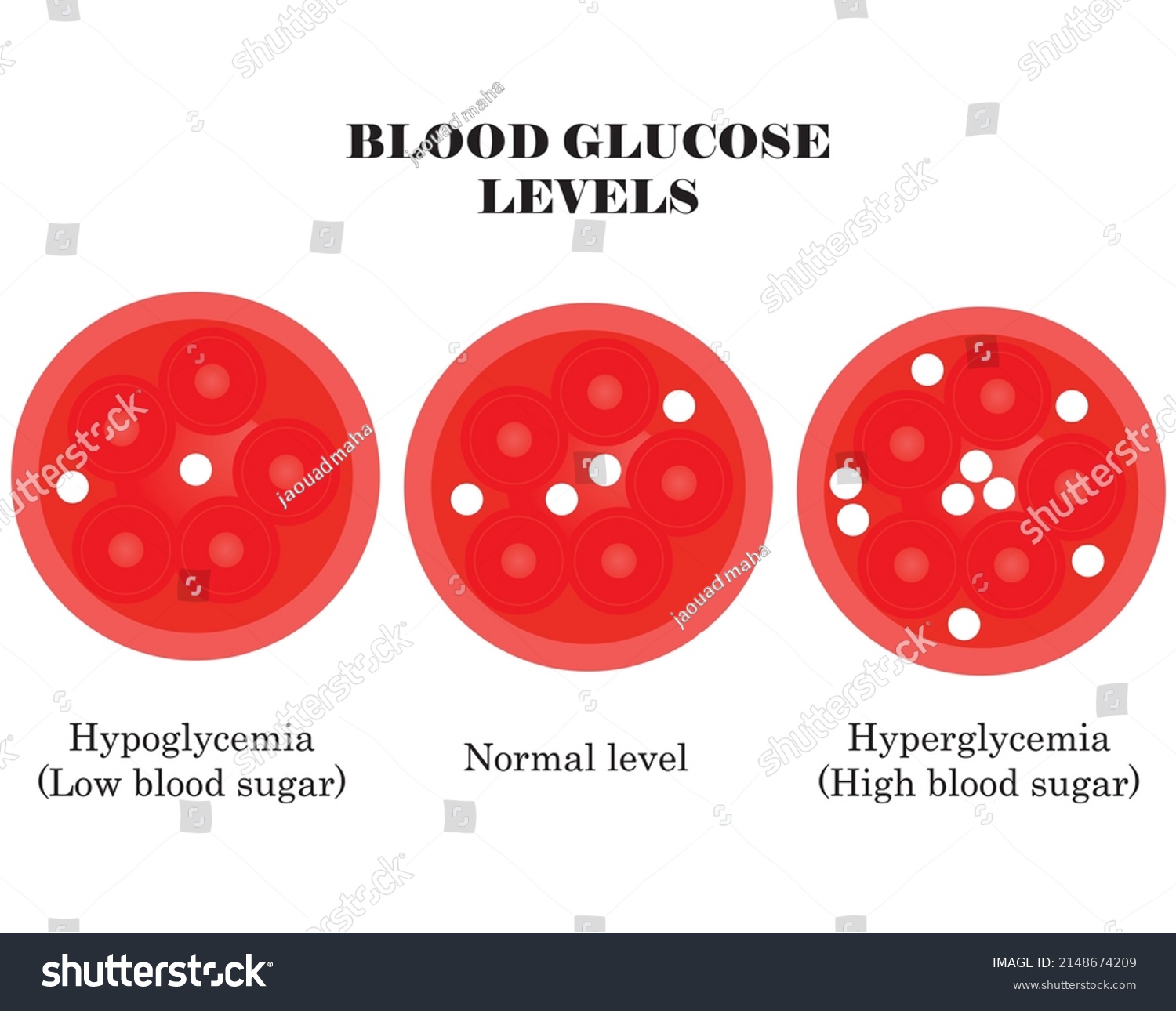 Blood Glucose Levels Diabetes Hypoglycemia Hyperglycemia Stock Vector ...