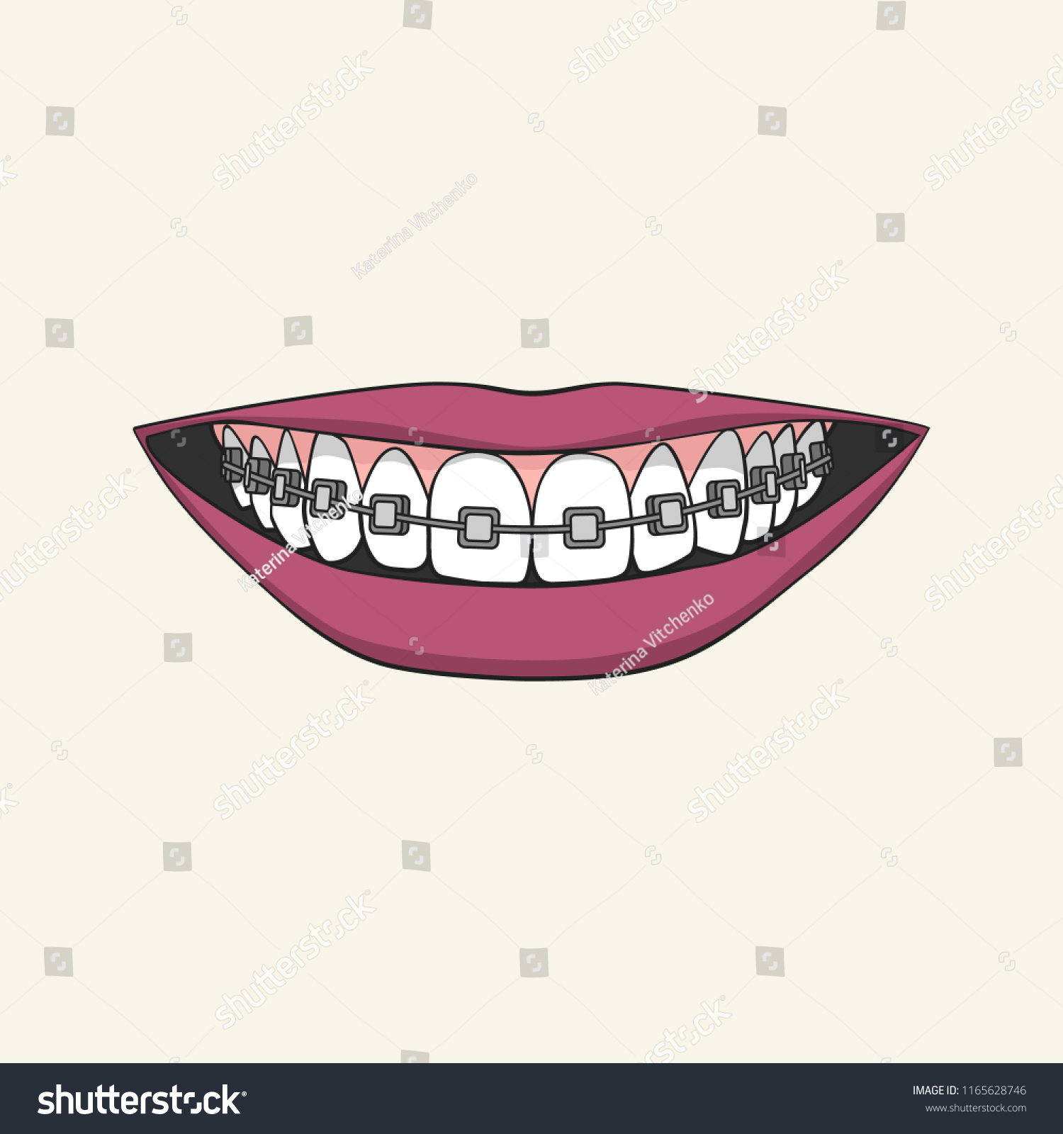 Braces Corrective Orthodontics Smiling Female Mouth Stock Vector ...