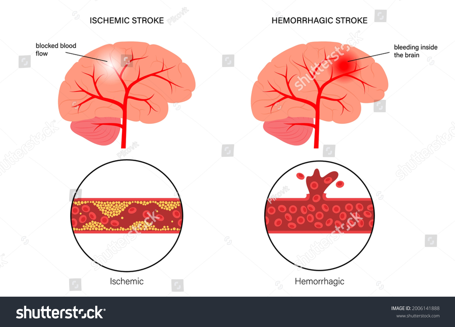 941 Rupture blood vessel Images, Stock Photos & Vectors | Shutterstock