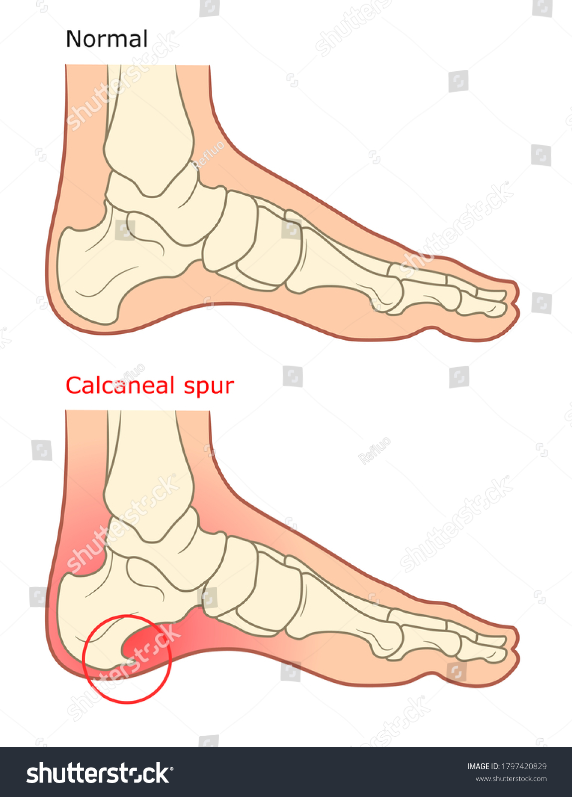 Calcaneal Spur Illustration Healthy Foot Diseased Stock Vector (Royalty ...