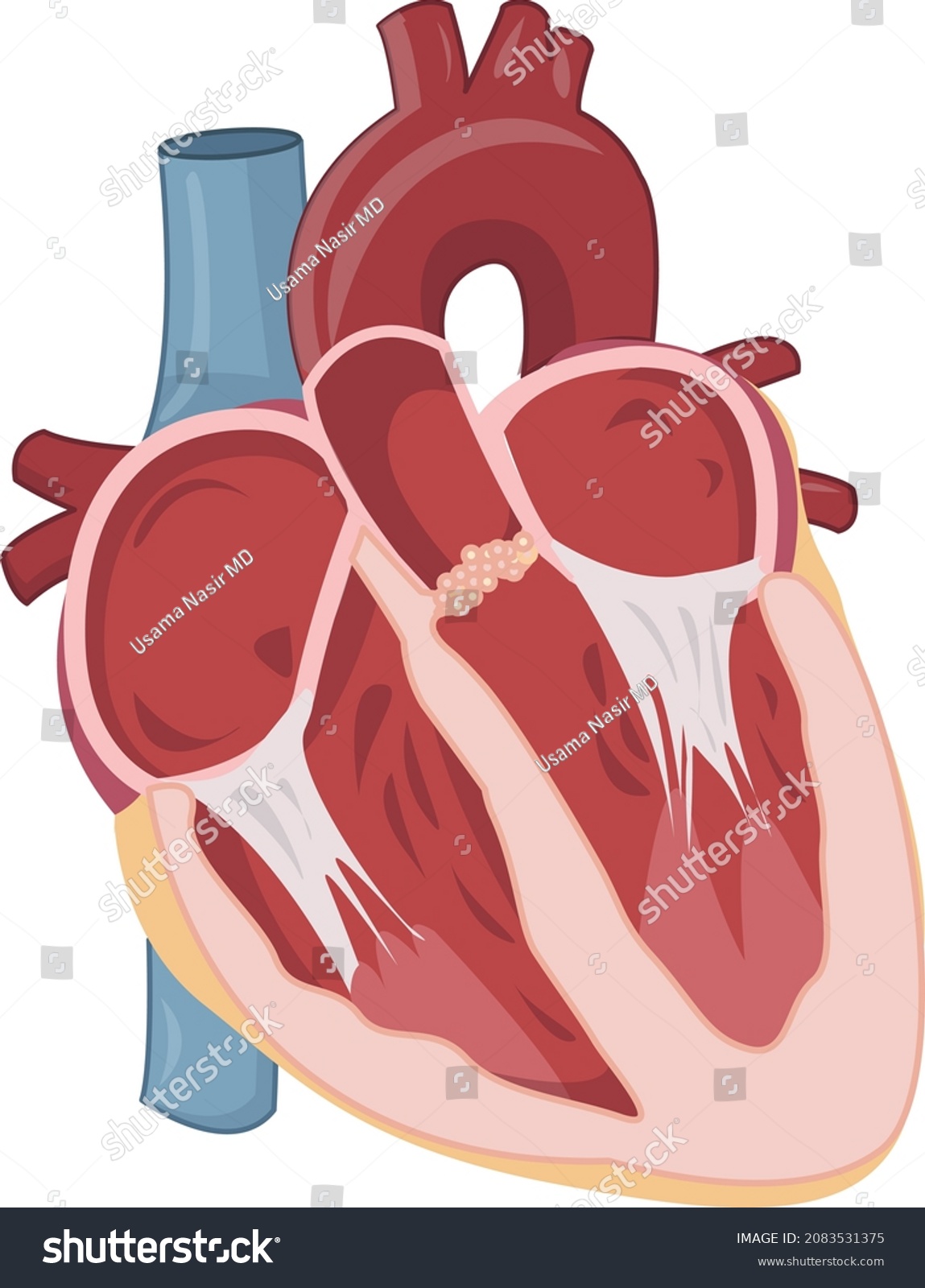 Calcified Aortic Disease Aortic Stenosis Illustration Stock Vector Calcified Aortic Disease Aortic Stenosis Illustration Stock Vector