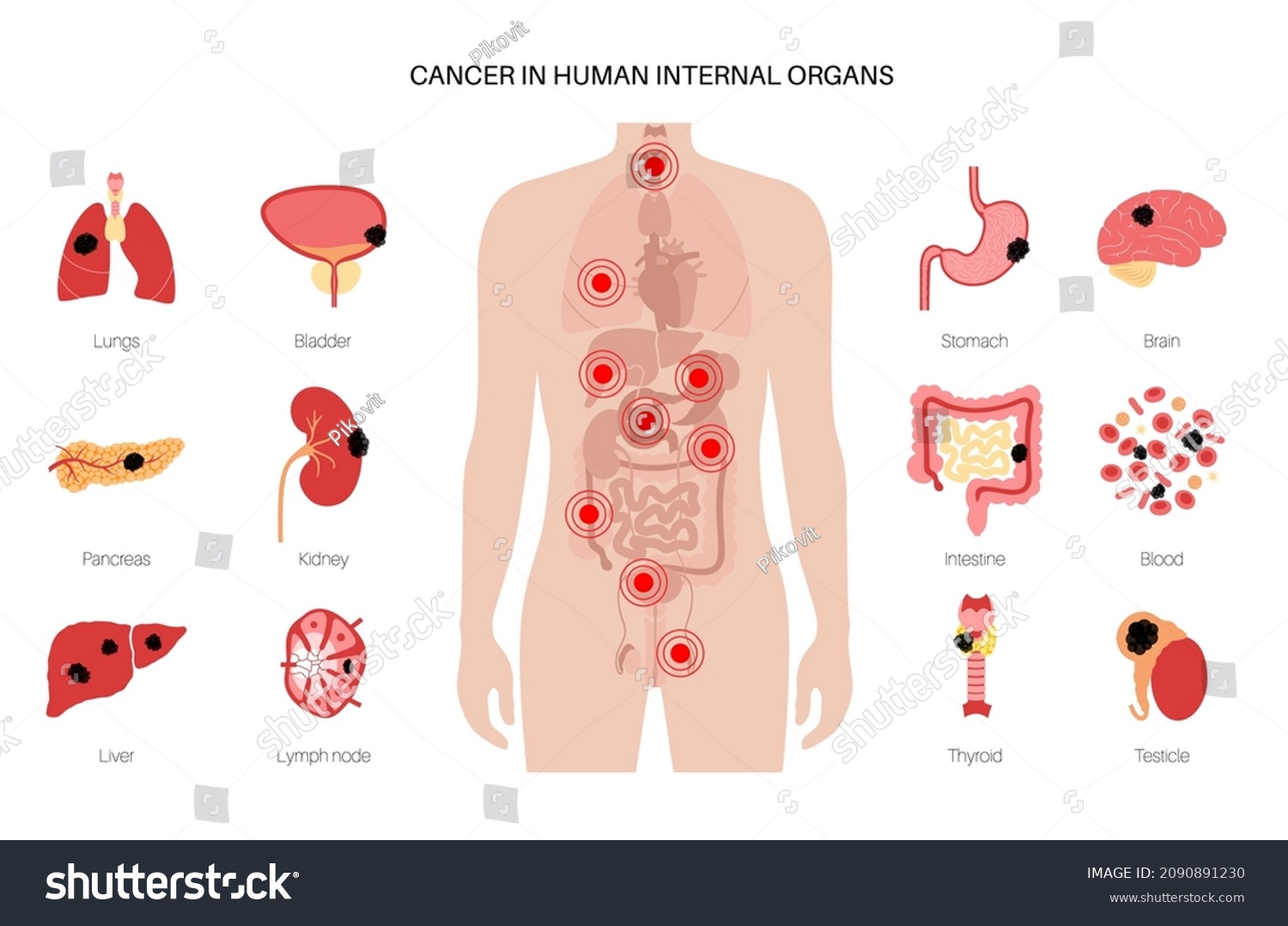 Cancer Internal Organs Tumor Man Body Stock Vector (Royalty Free ...