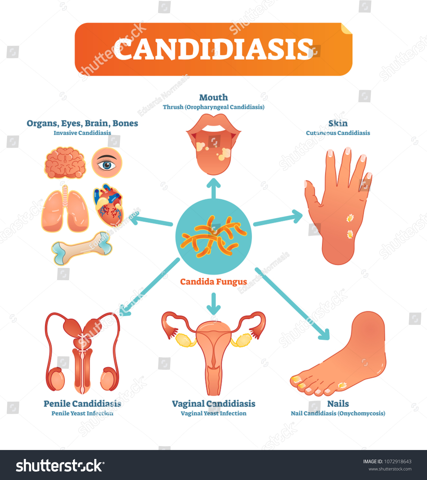 thrush español candida thrush español candida