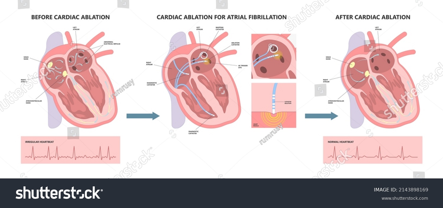 SVG of Cardiac catheter ablation Atrial fibrillation minimally invasive procedure rhythm problem cath lab treat treatment Coronary x-ray Radio frequency Sinus Ventricular SVT ECG ICD Radiofrequency attack svg