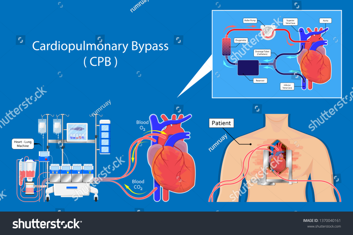 Cardiopulmonary Bypass Heart Lung Machine Coronary Stock Vector ...