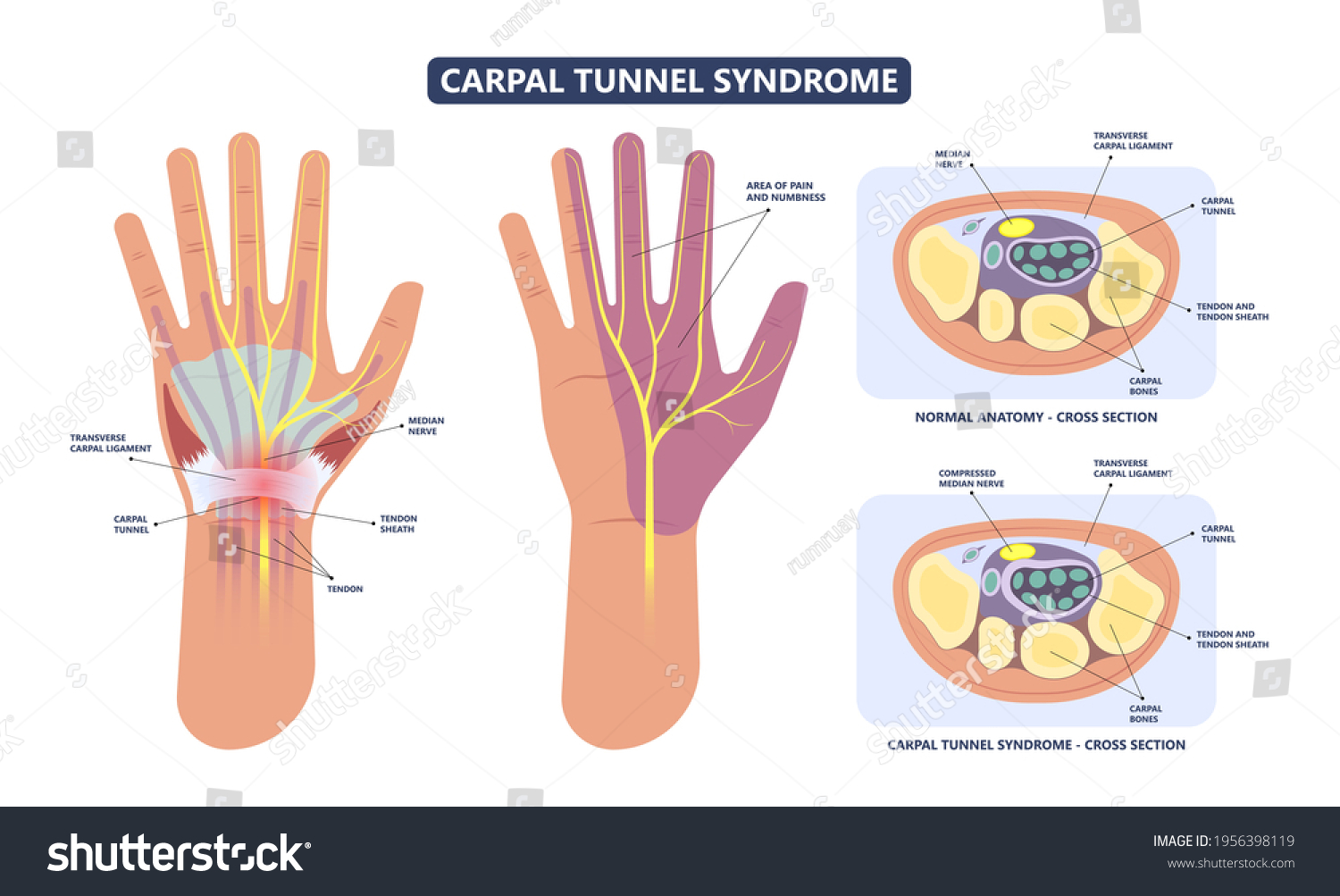 Tunnel carpal Common Causes
