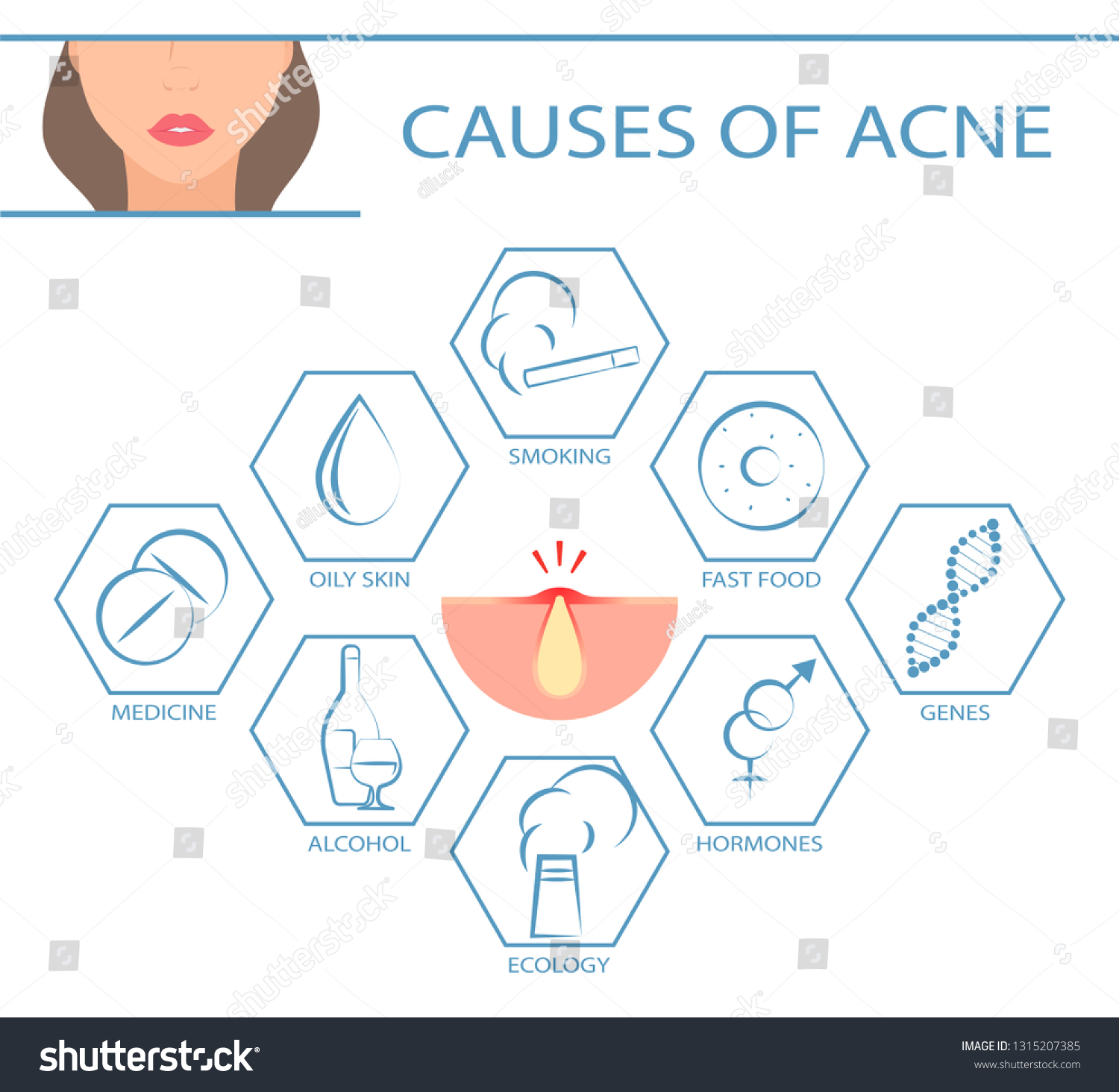 Causes Acne Infographic Dermatology Skin Problems Stock Vector