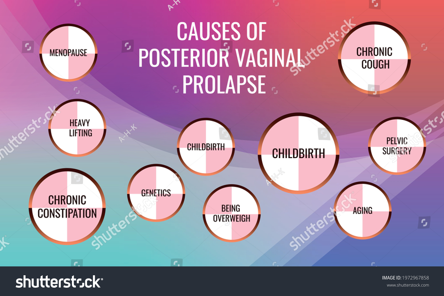 Causes Posterior Vaginal Prolapse Vector Illustration Stock Vektorgrafik Lizenzfrei