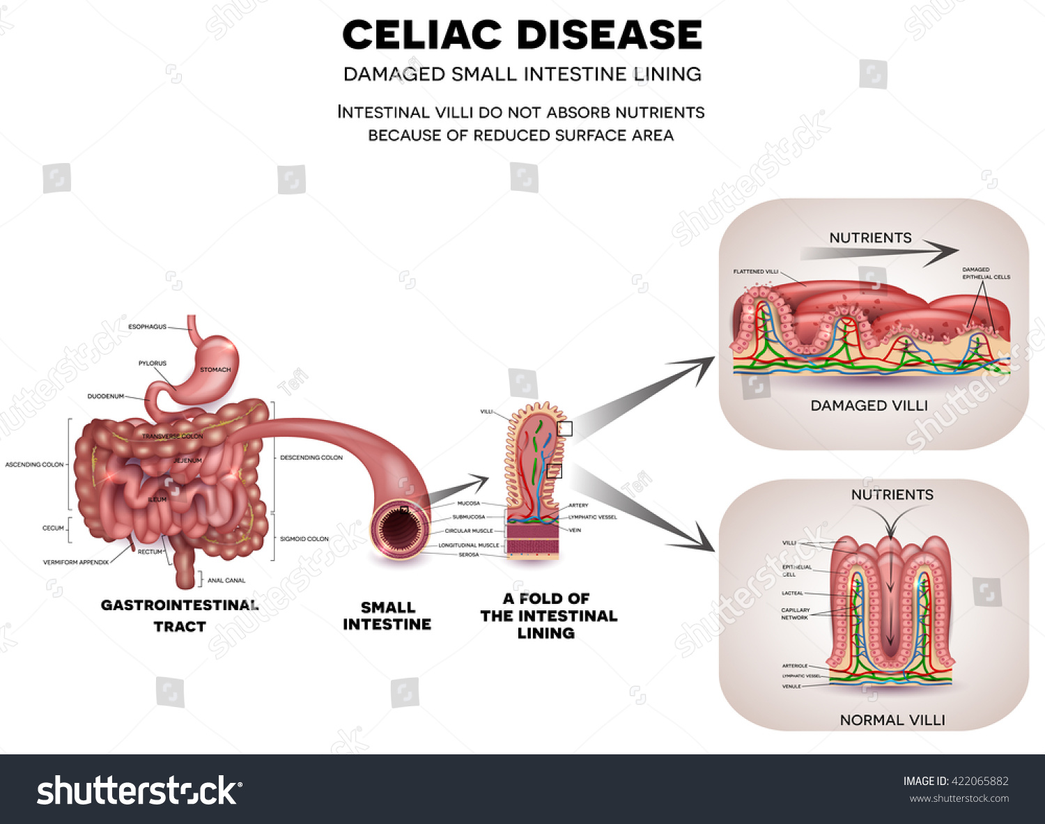 stock vector celiac disease affected small intestine healthy and unhealthy villi with damaged cells nutrients 422065882