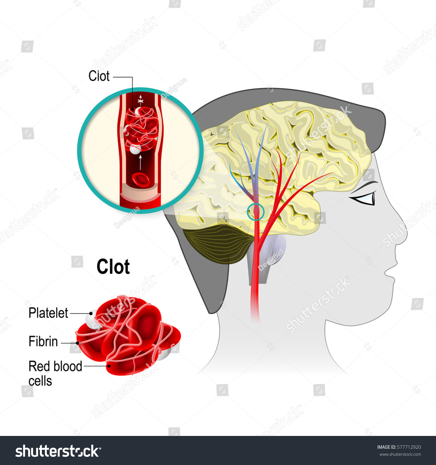 Cerebral Infarction Brain Stroke Obstruction Caused Stock Vector Royalty Free 577712920