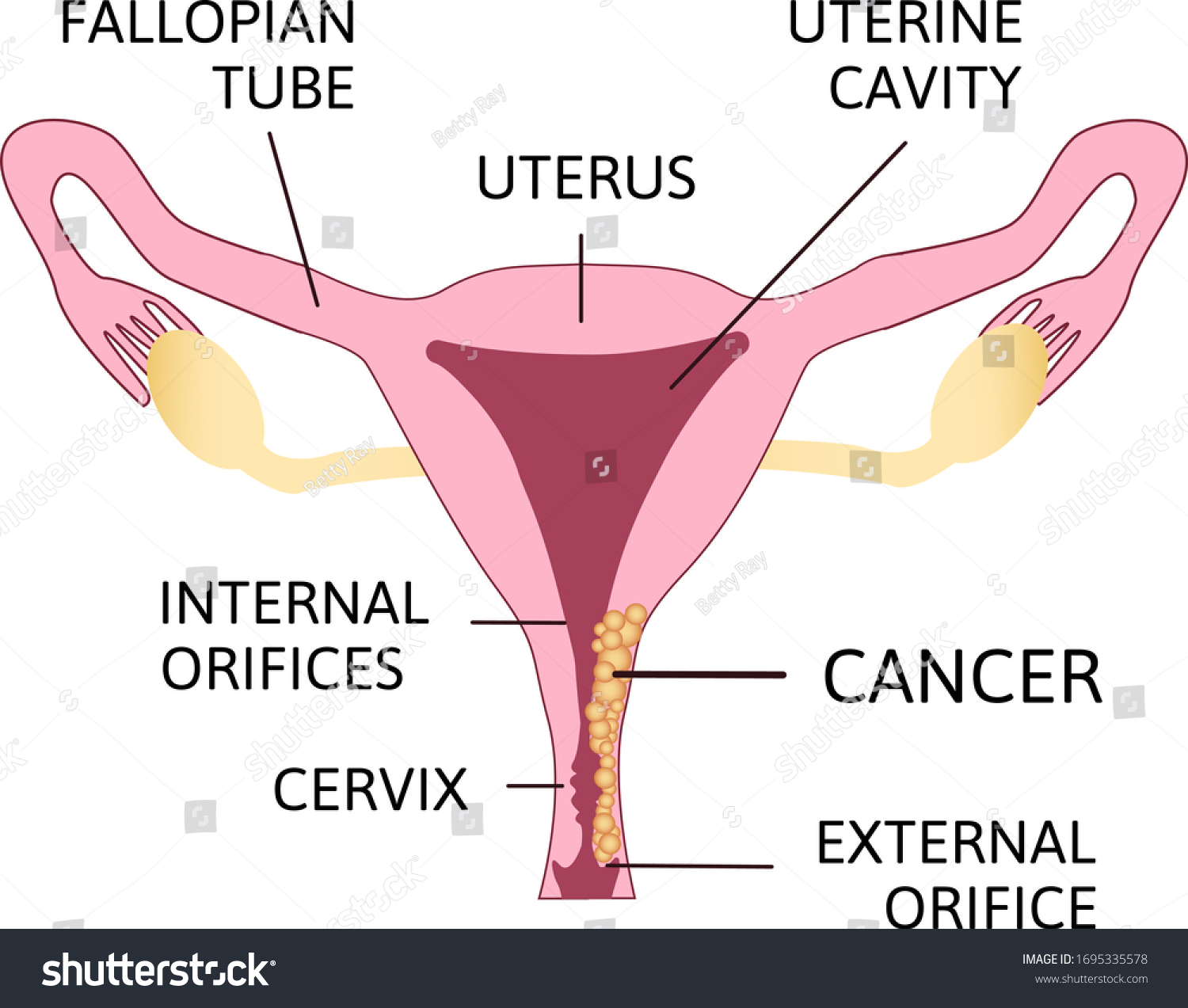 Cervical Cancer Carcinoma Cervix Malignant Neoplasm เวกเตอร์สต็อก ปลอดค่าลิขสิทธิ์ 1695335578