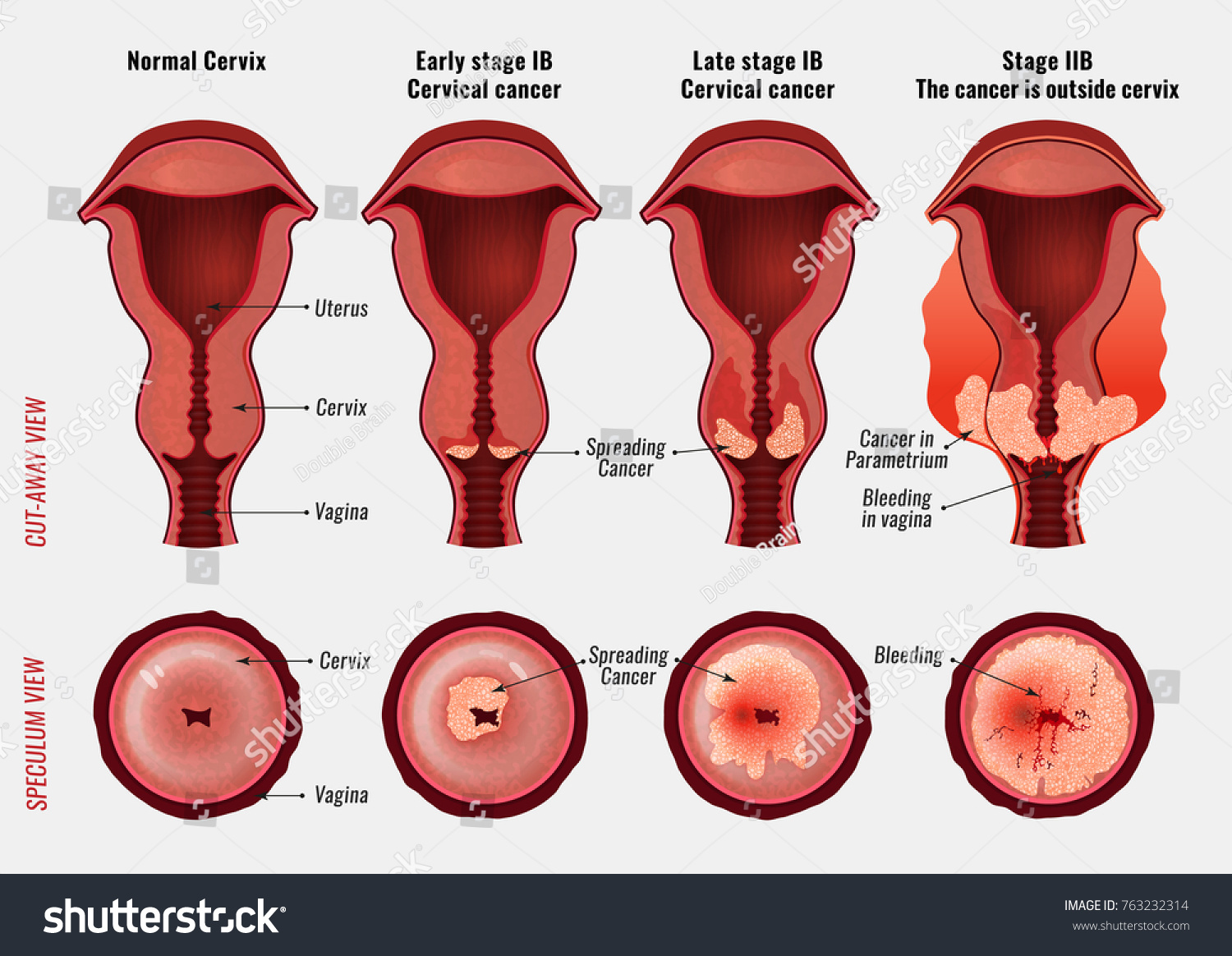 136-stages-of-cervical-cancer-images-stock-photos-vectors-shutterstock