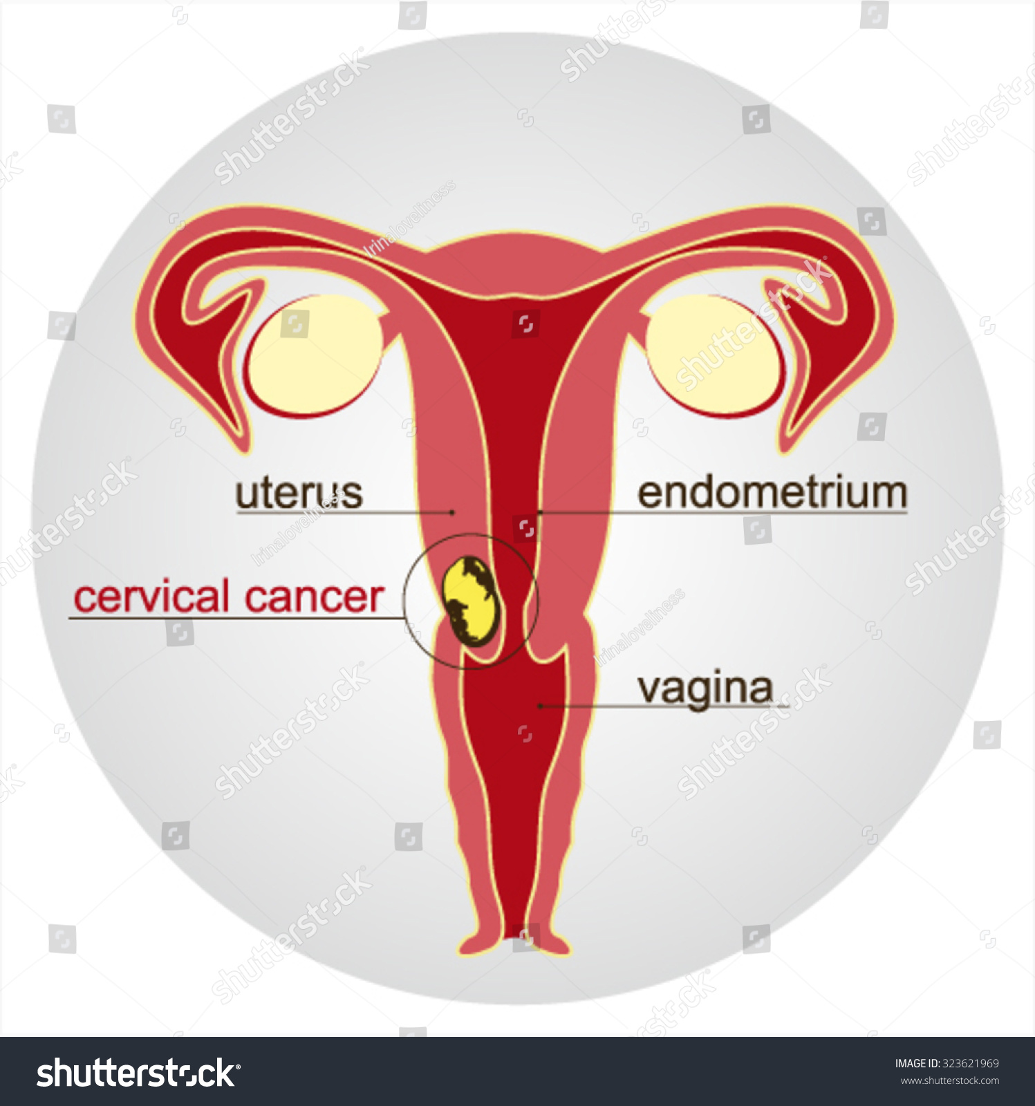 Cervical Cancerschematic Illustration Vector Illustration Stock Vector Royalty Free 323621969 