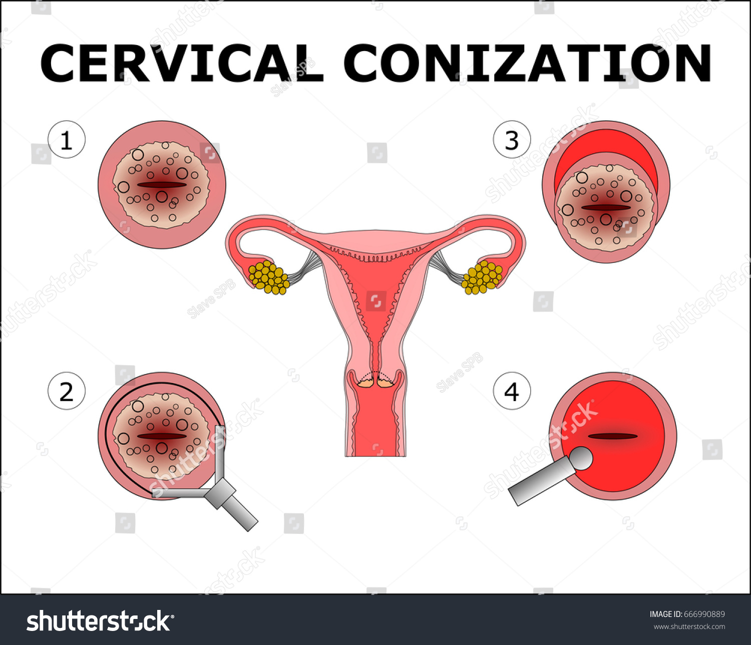 Cervical Conization Vector Color Illustration Stock Vector (Royalty ...