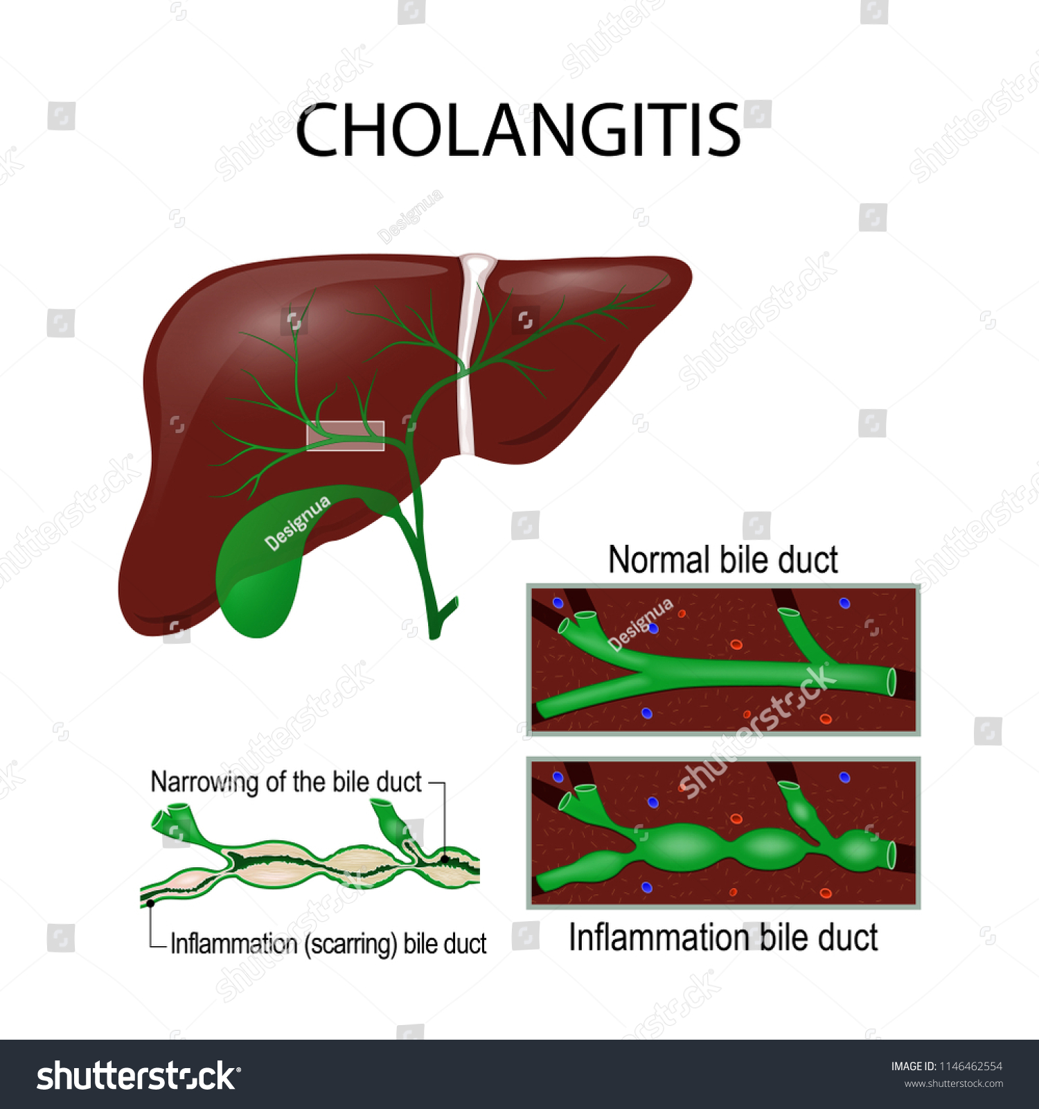 Cholangitis images, photos et images vectorielles de stock Shutterstock