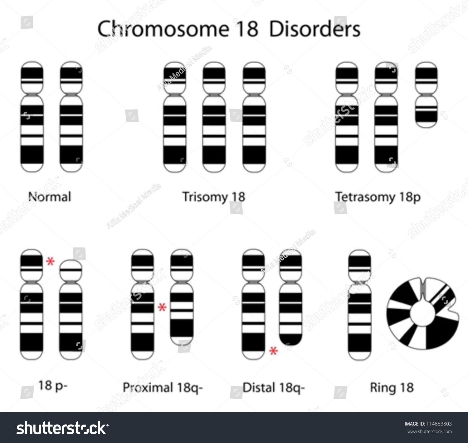 Chromosome 18 Disorders Stock Vector Illustration 114653803 : Shutterstock