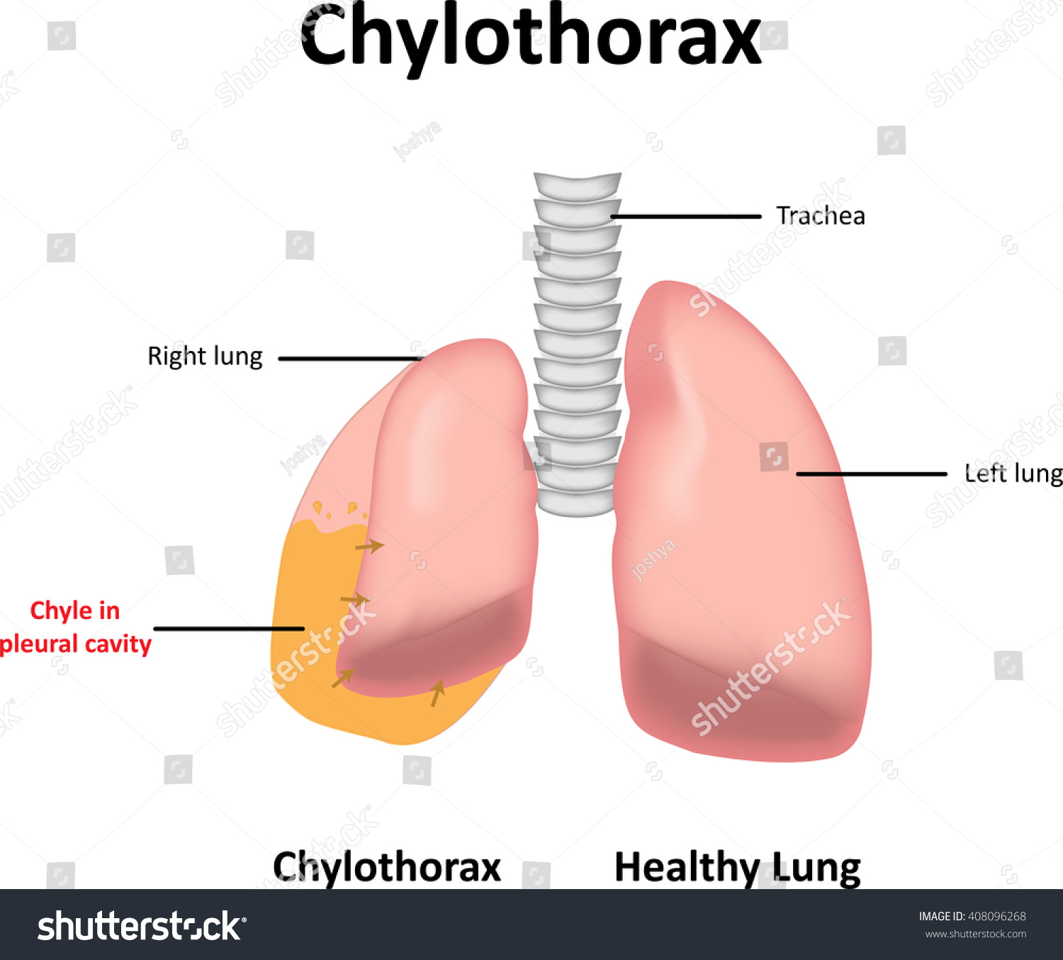 Chylothorax Illustration Stock Vector (Royalty Free) 408096268