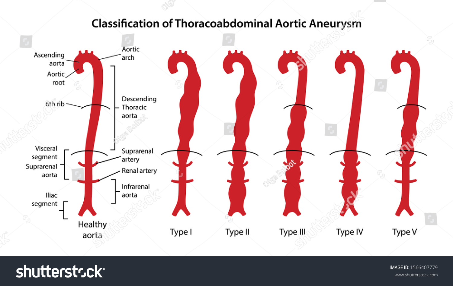 Vektor Stok Classification Thoracoabdominal Aortic Aneurysms Healthy ...