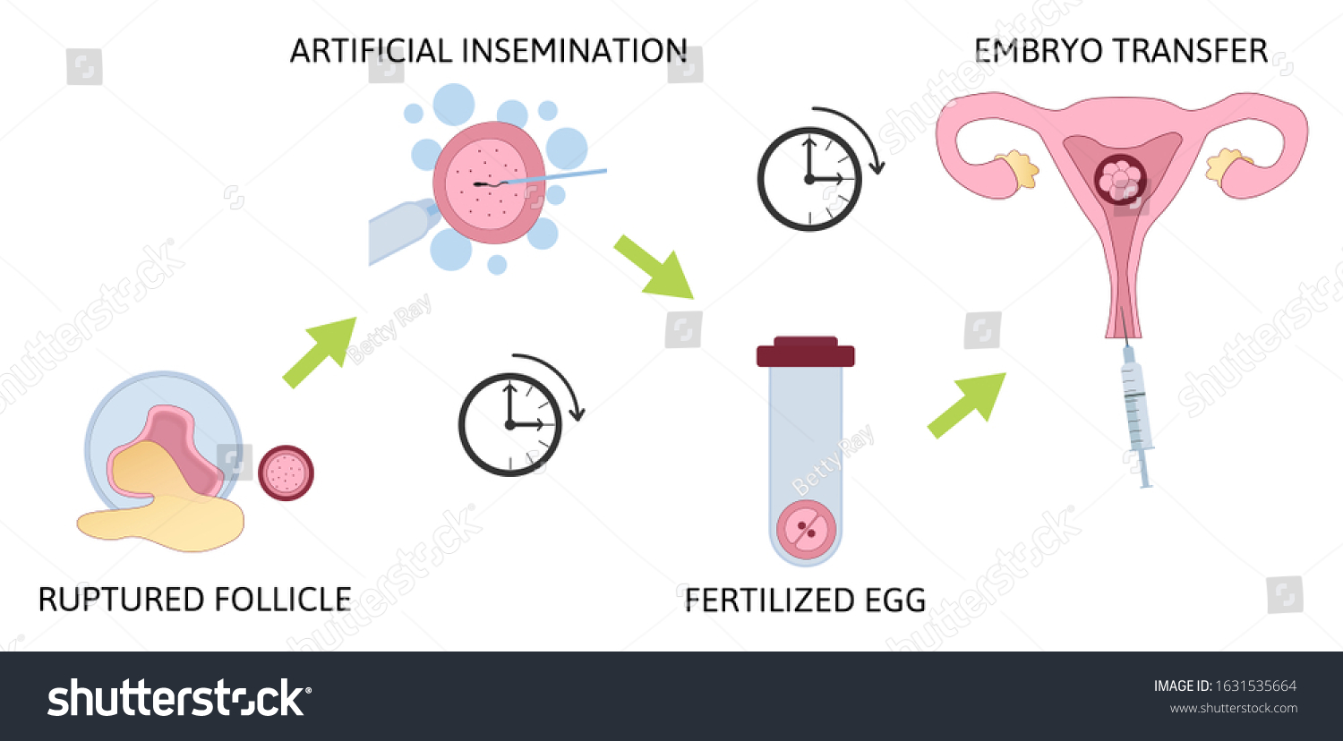 Colored Vitro Fertilization Ivf Flat Infographics Stock Vector (Royalty ...