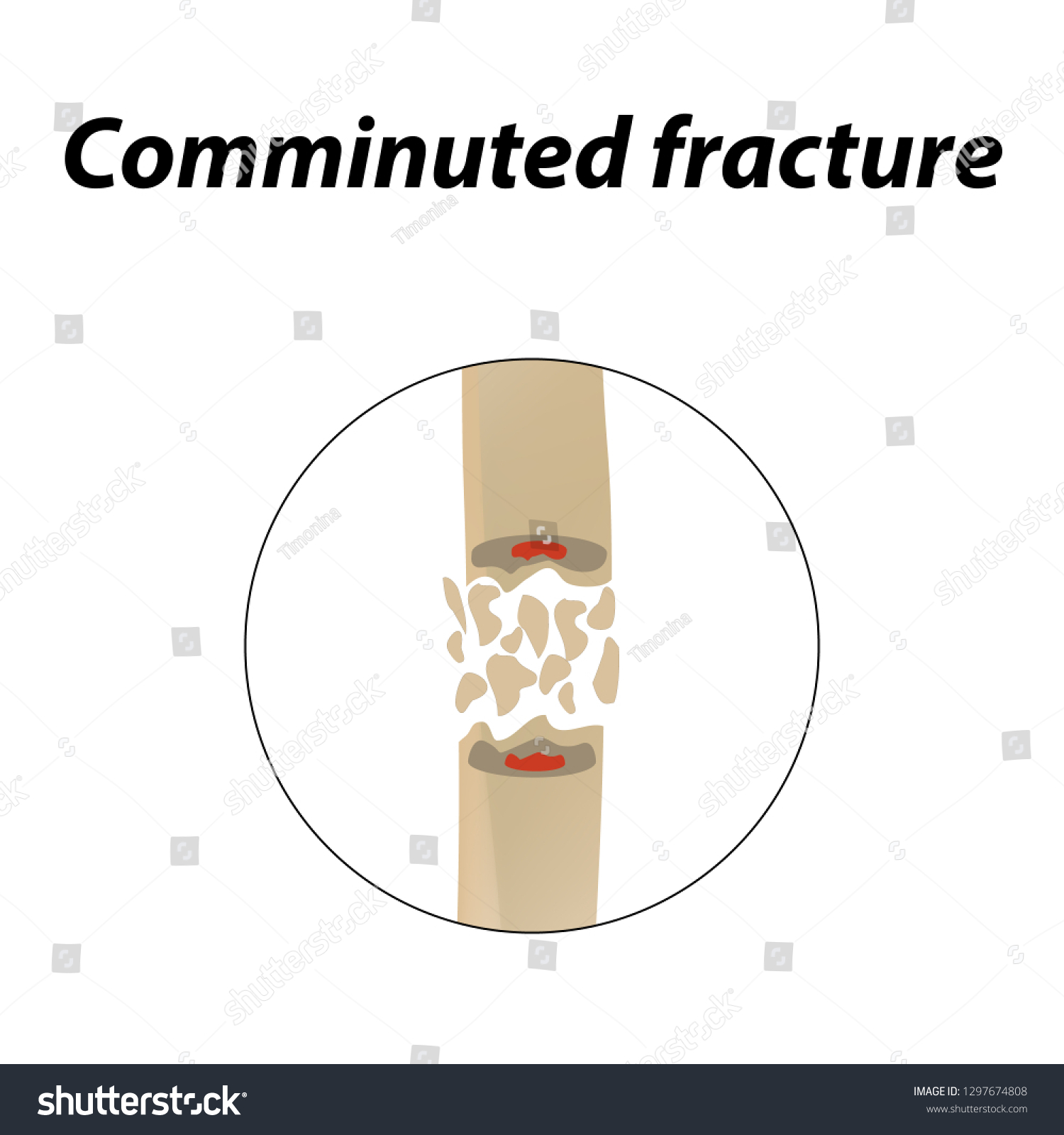 Comminuted Fracture Bone Infographics Vector Illustration Stock Vector Royalty Free 1297674808 0859