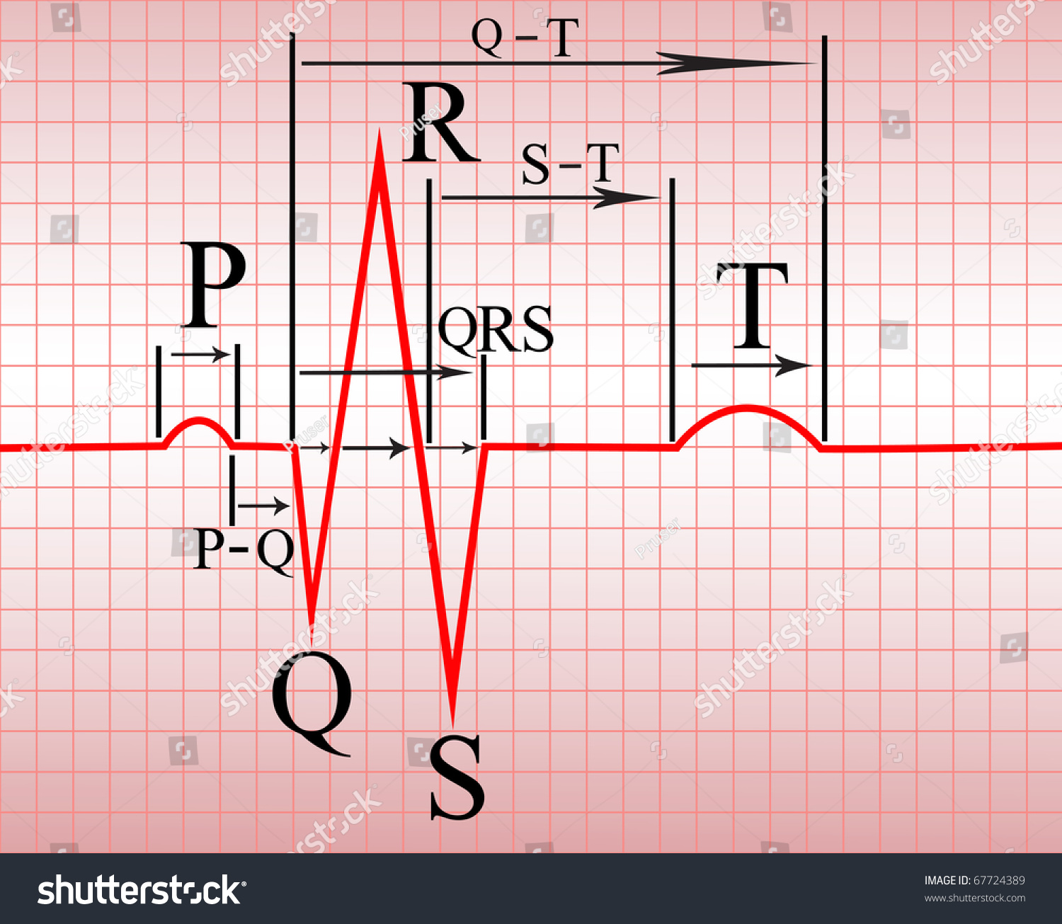 Complex Of Ecg On Thermal Paper, With The Notation Of Teeth And Spacing ...