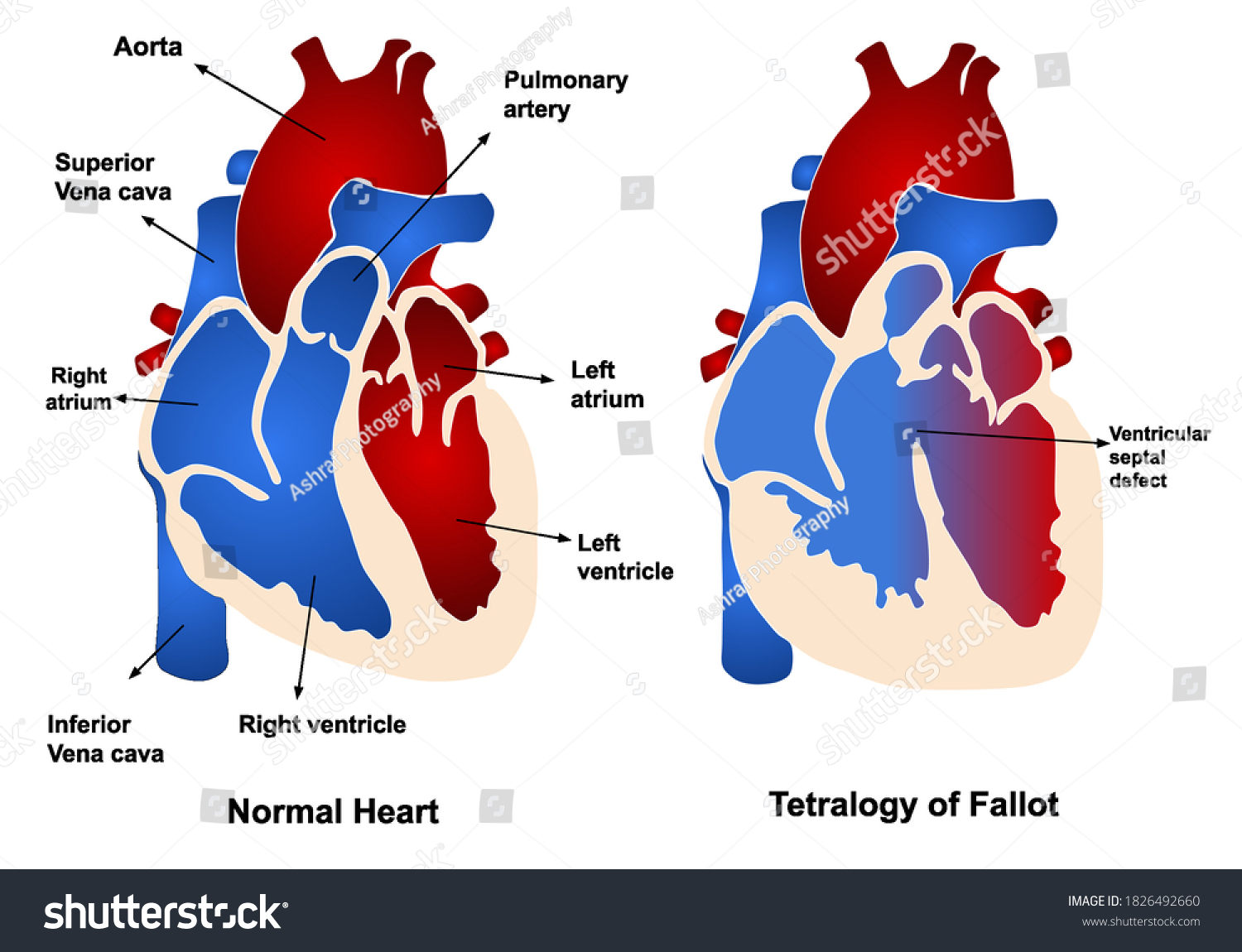 Congenital Heart Disease Tetralogy Fallot Stock Vector Royalty Free 1826492660