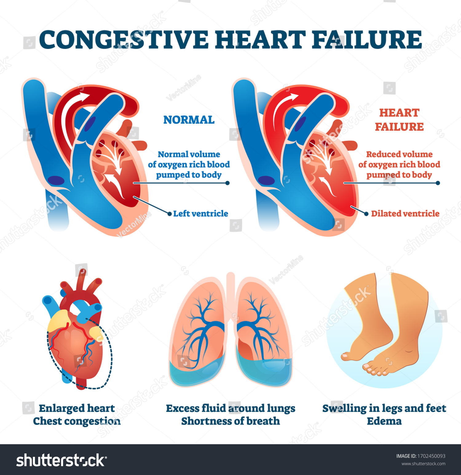 congestive-heart-failure-imagens-fotos-e-vetores-stock-shutterstock