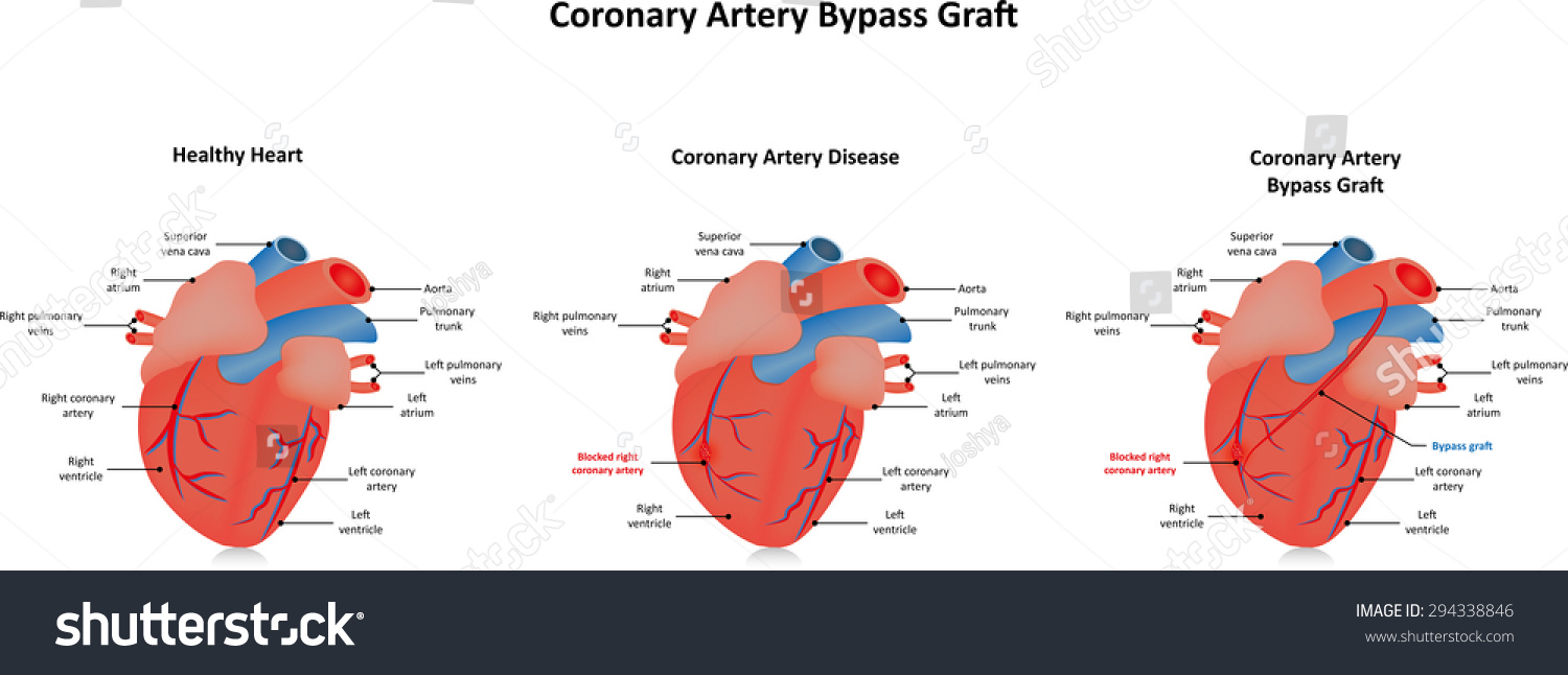 Free Free Svg Heart Graft 941 SVG PNG EPS DXF File