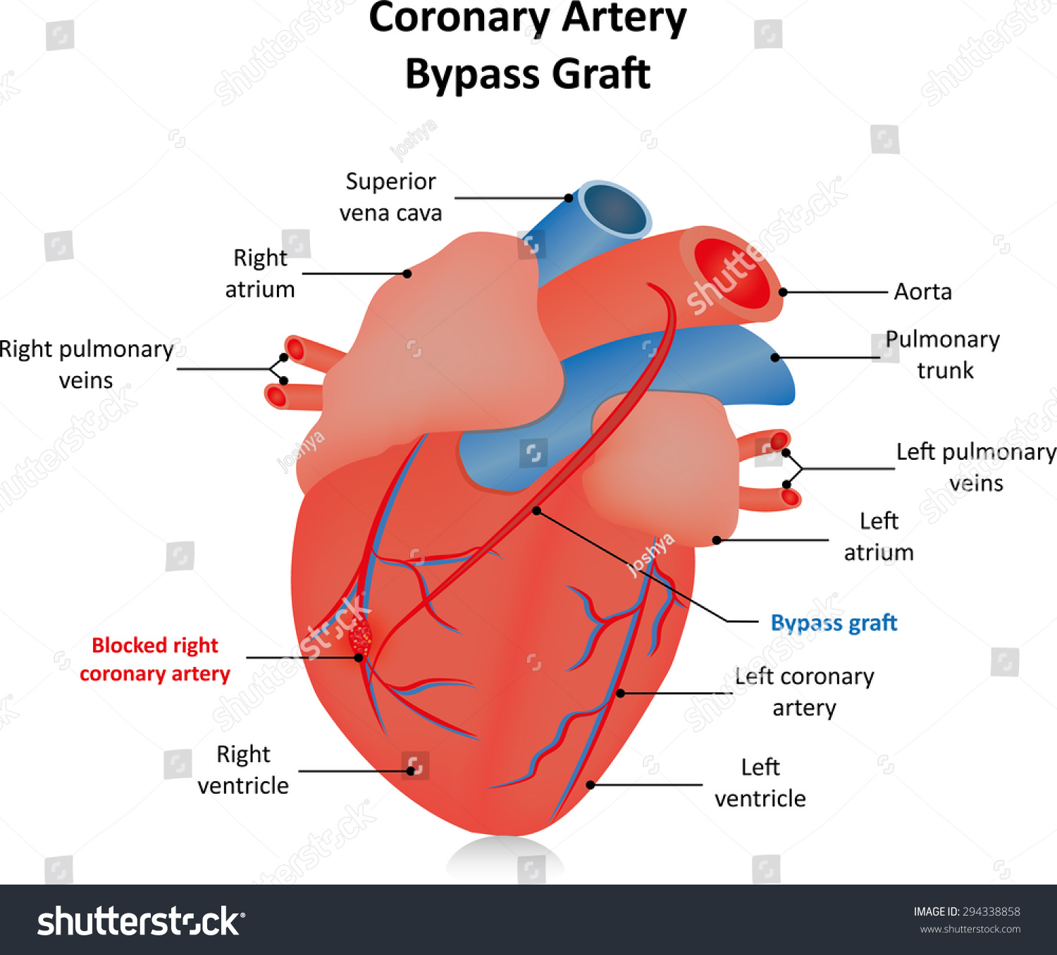 Coronary Artery Bypass Graft Labeled Diagram Stock Vector ...