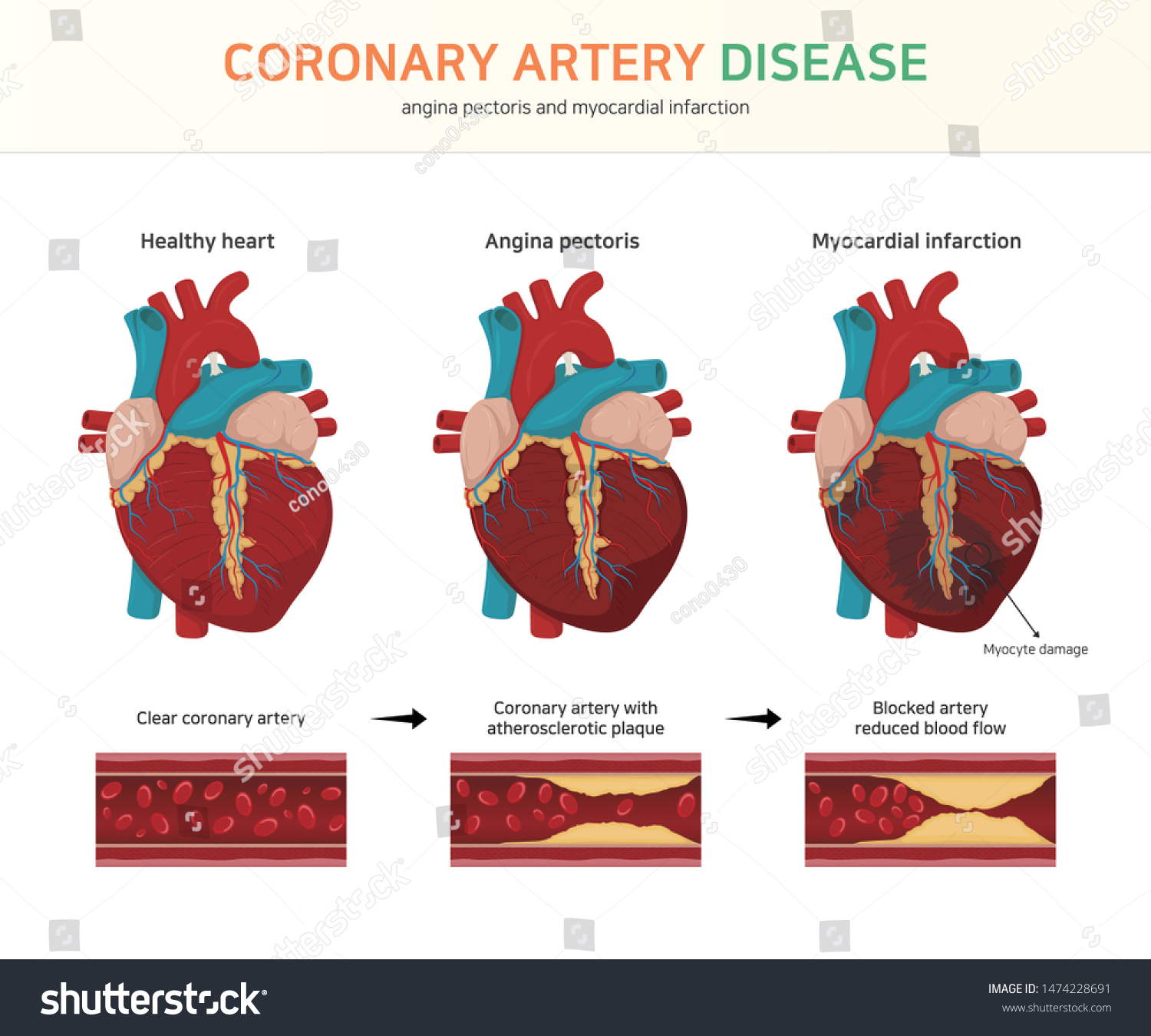 koronare Herzkrankheit. (Angina pectoris und Myokardinfarkt): Stock