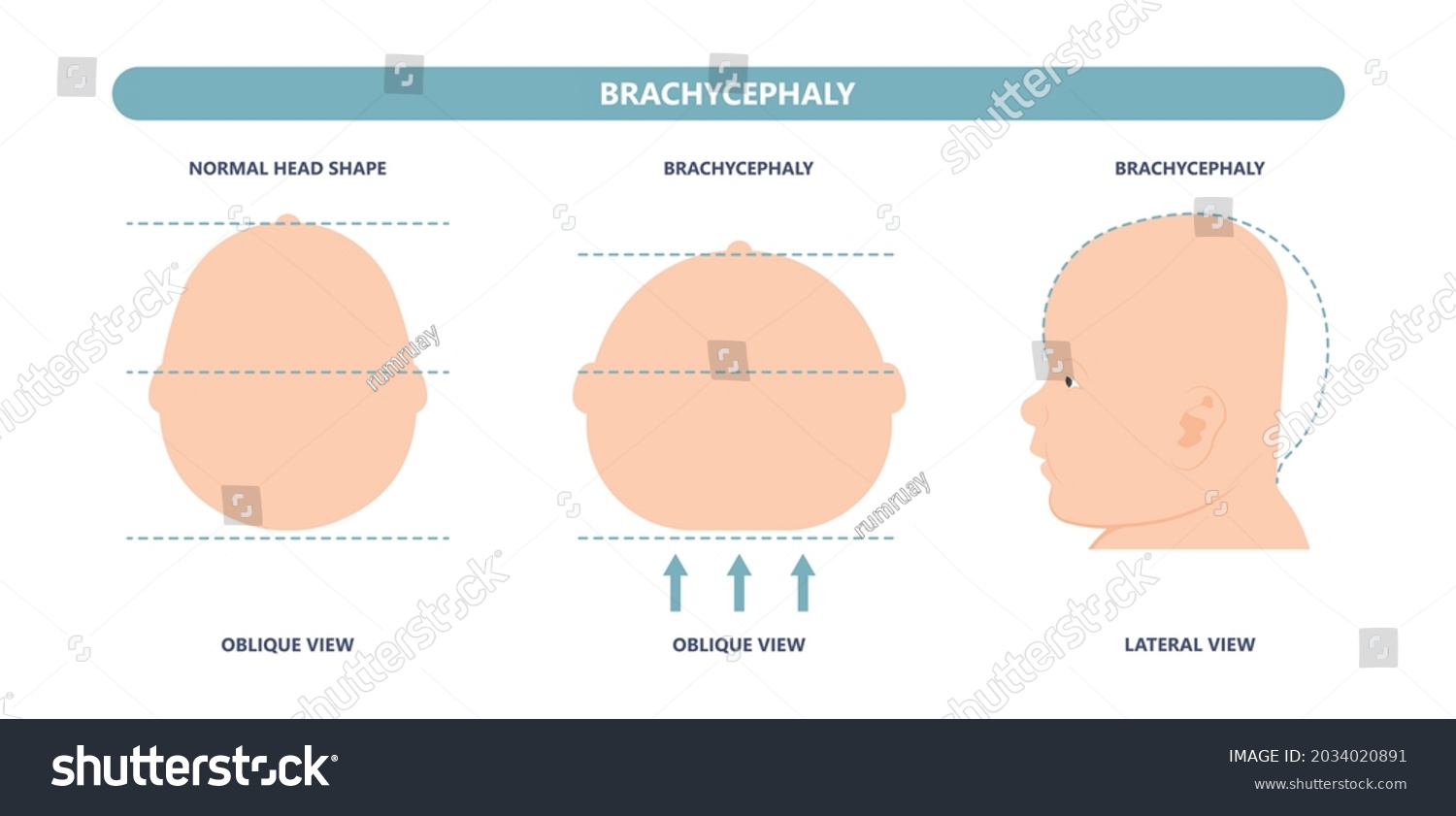 SVG of craniosynostosis helmet pillow flat head autism brain skull bone deformity baby infant child newborn defect birth anterior Metopic Born genes genetic position sleep shape deformation tummy time svg