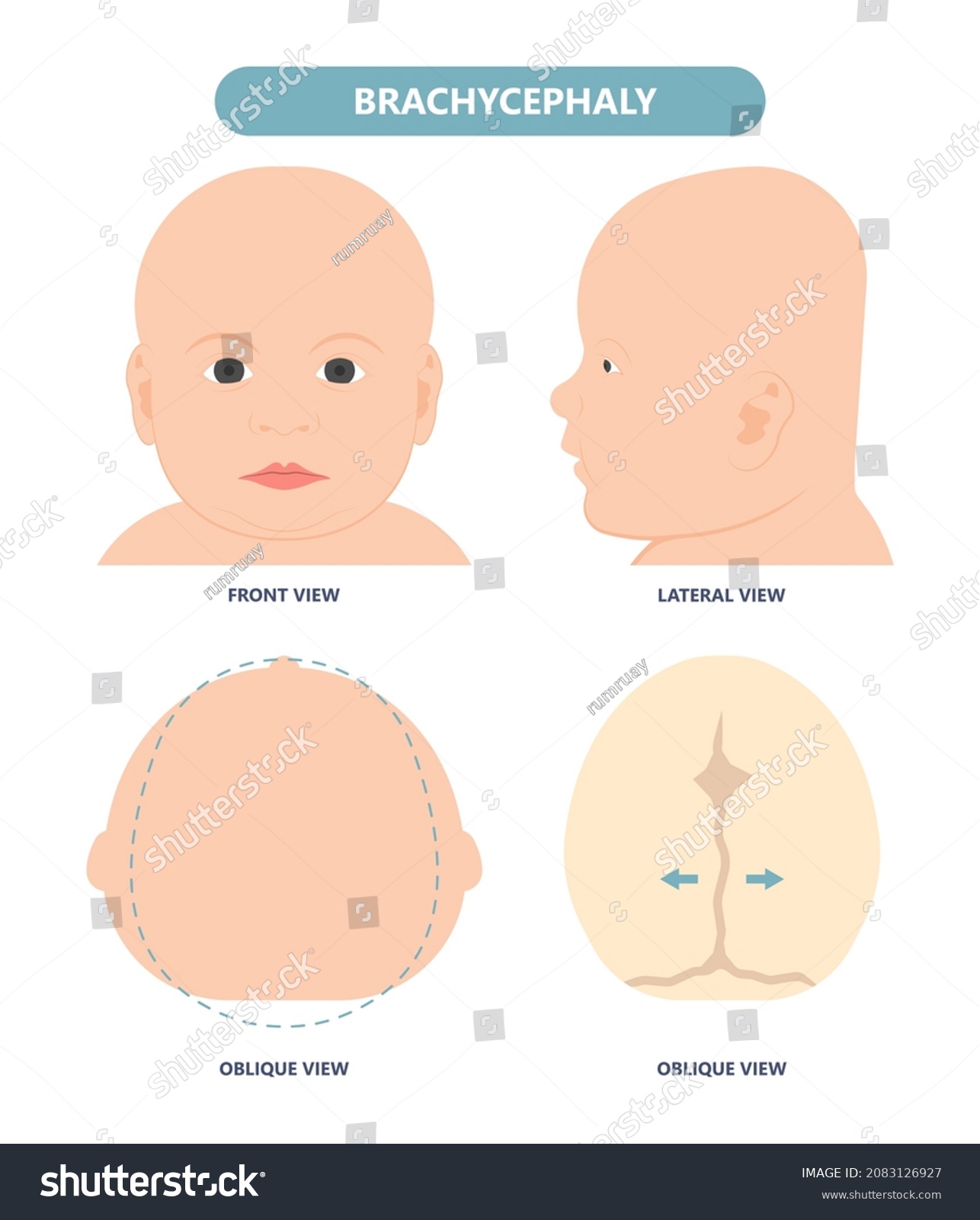 SVG of craniosynostosis helmet pillow flat head autism brain skull bone deformity baby infant child newborn defect birth anterior Metopic Born genes genetic position sleep shape deformation tummy time svg