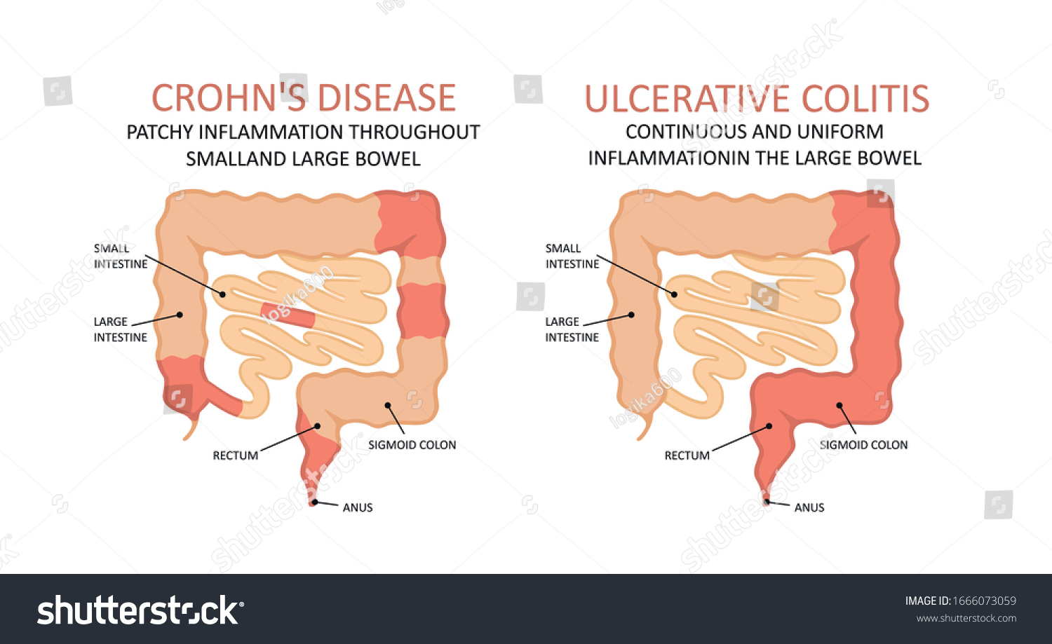 Ulcerative Colitis Imágenes Fotos De Stock Y Vectores Shutterstock 