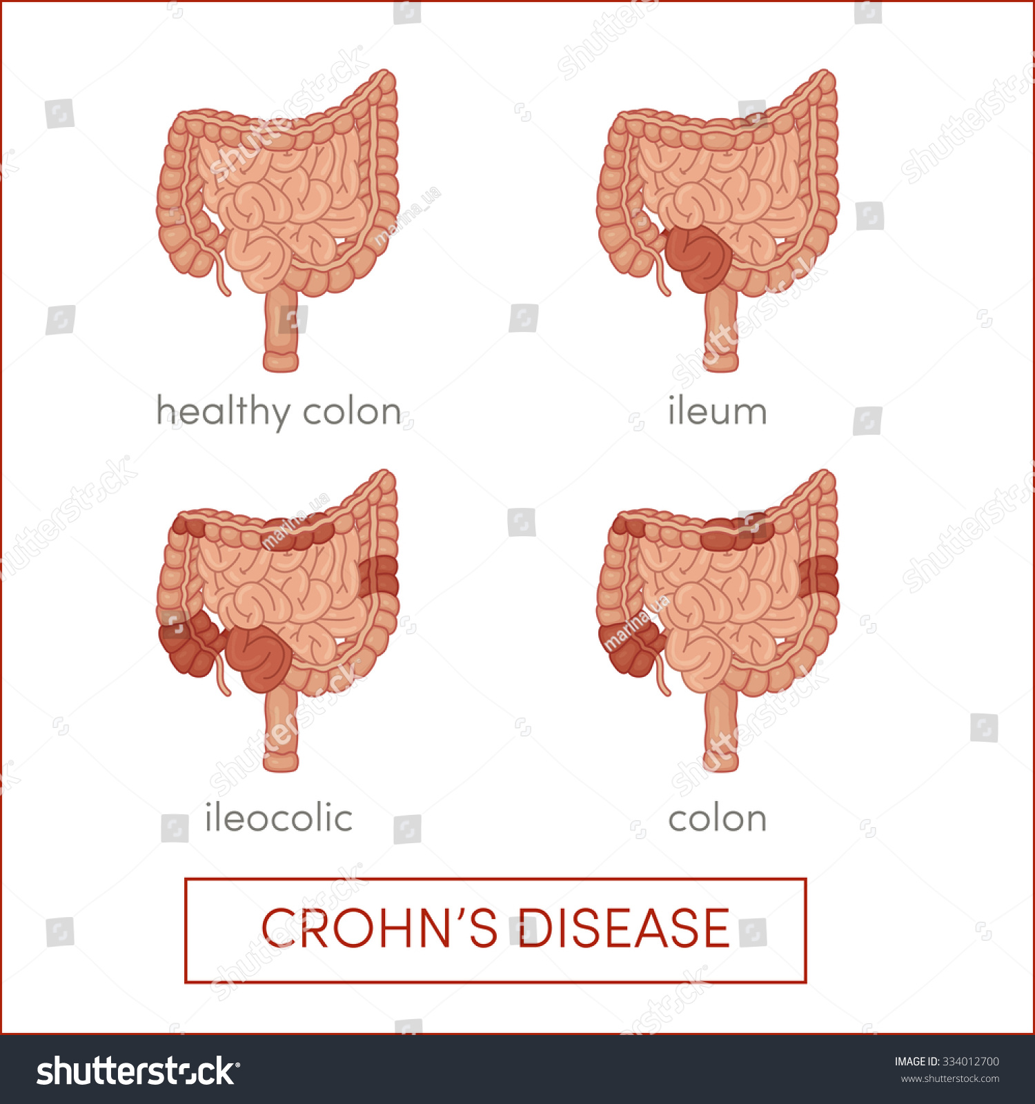 Enfermedad De Crohn Enfermedad Intestinal Inflamatoria Vector De Stock Libre De Regalías 2655