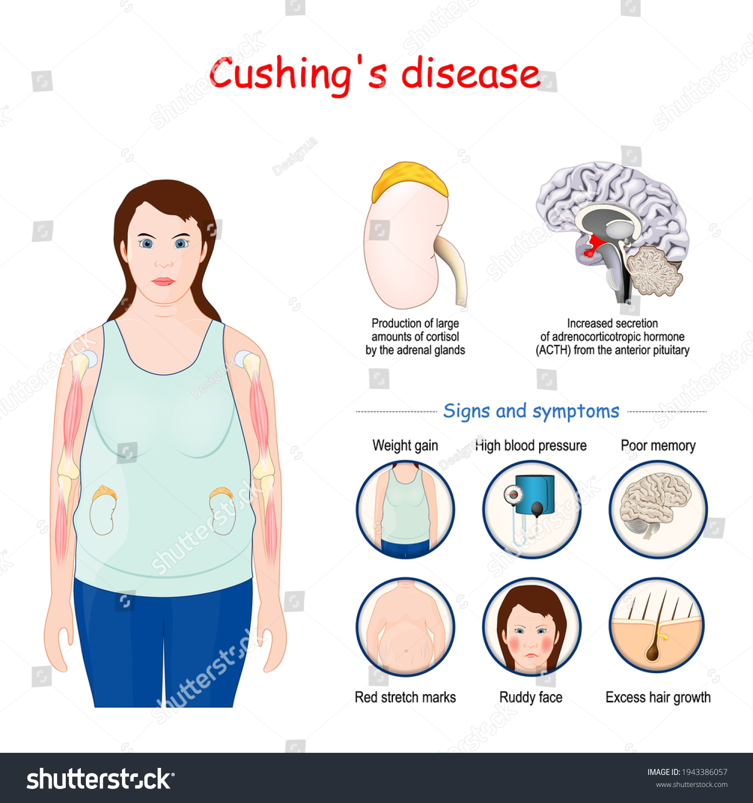 Cushings Disease Signs Symptoms Cushing Syndrome Stock Vector (Royalty ...