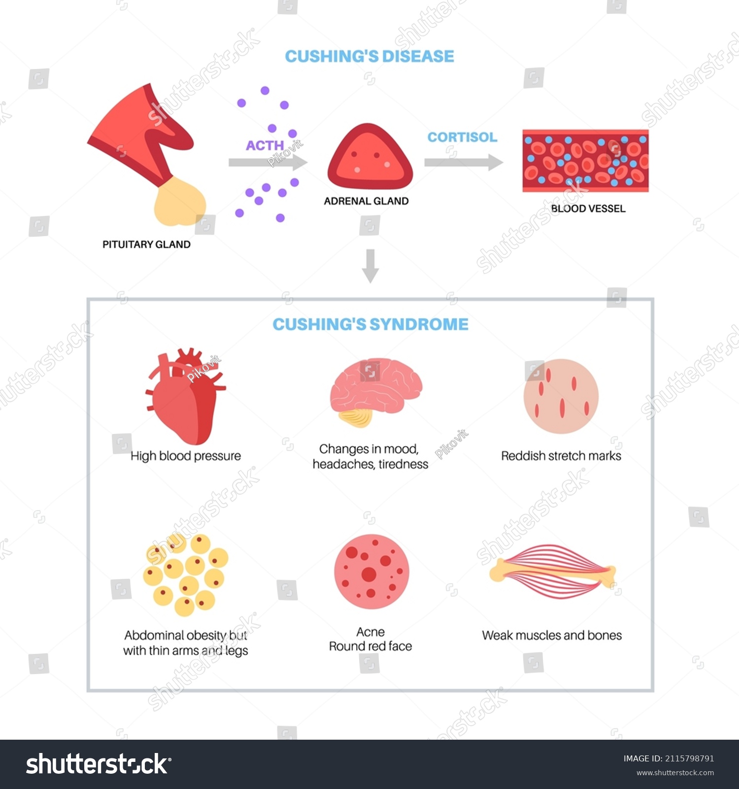 Cushing Syndrome Disease Infographic Poster Cortisol Stock Vector Royalty Free 2115798791 