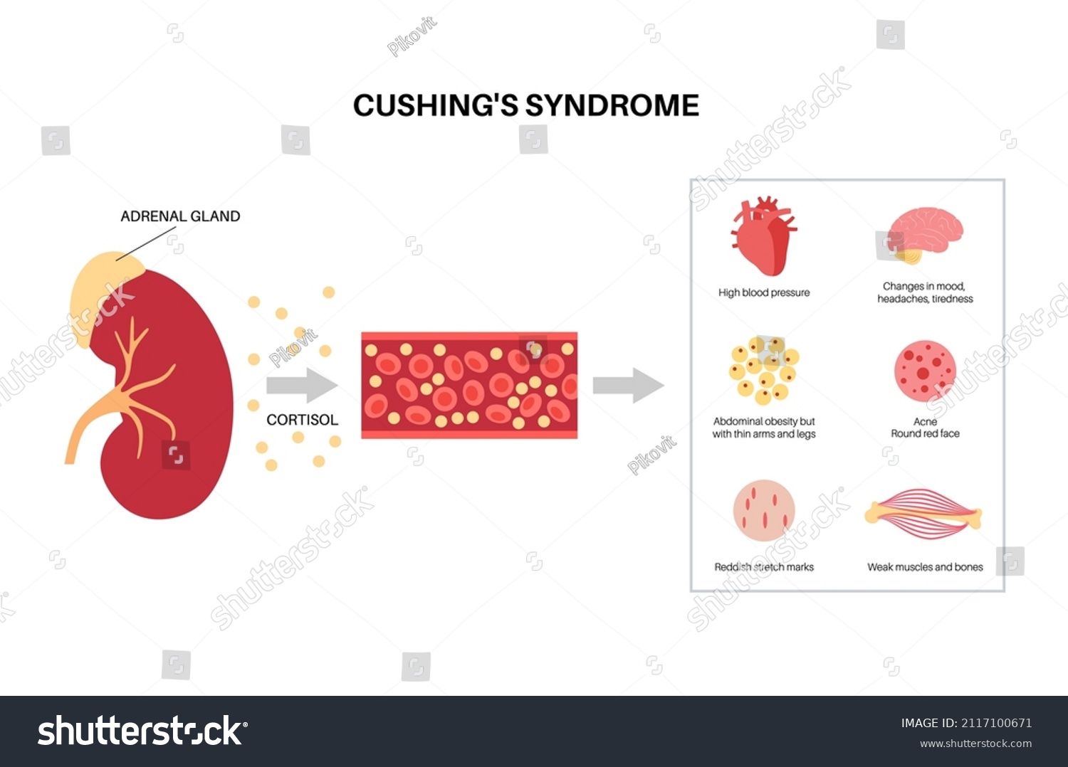 Cushing Syndrome Disease Infographic Poster Cortisol Stock Vector Royalty Free 2117100671 