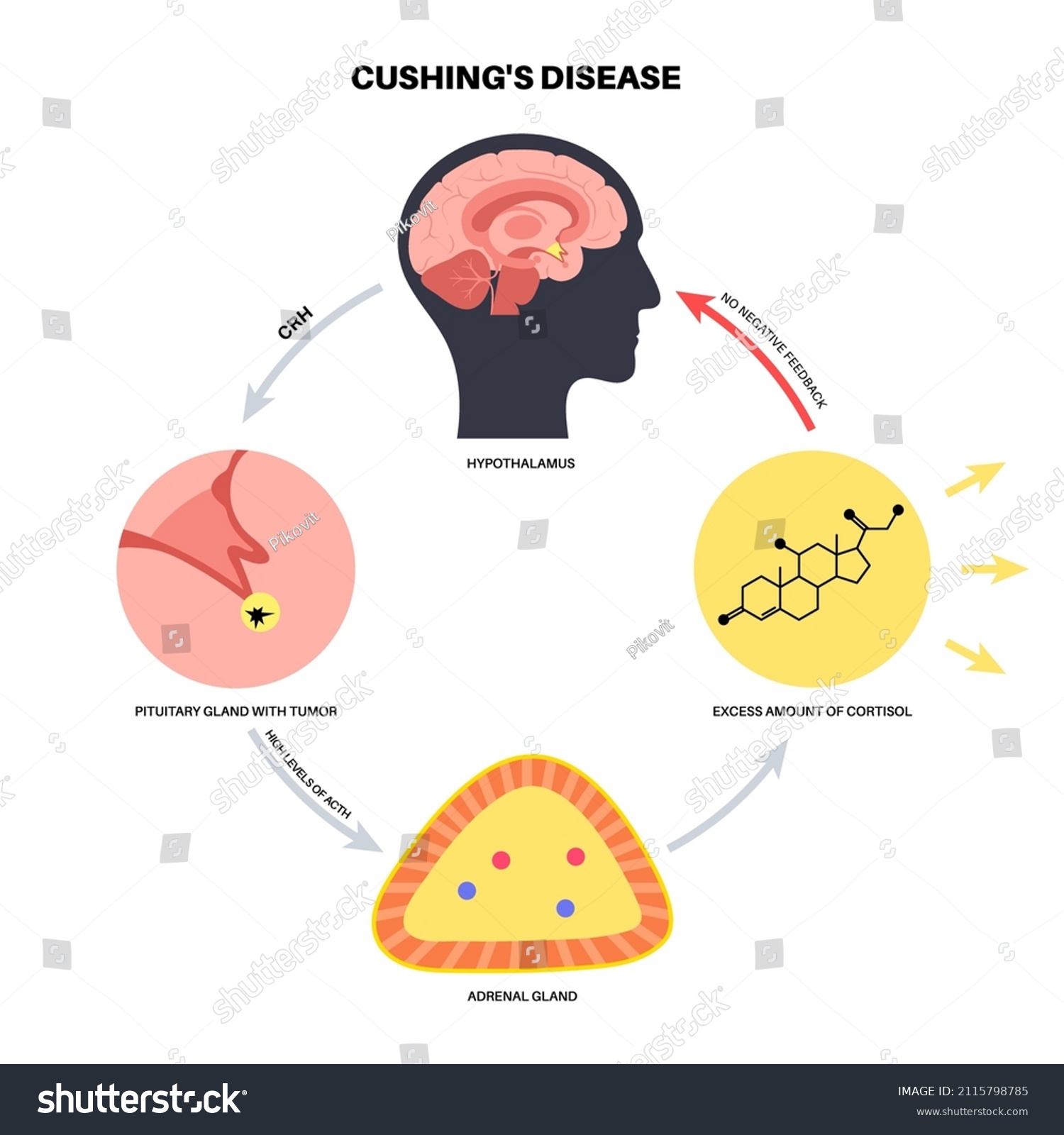 Cushing Syndrome Disease Medical Poster Pituitary Stock Vector (Royalty ...