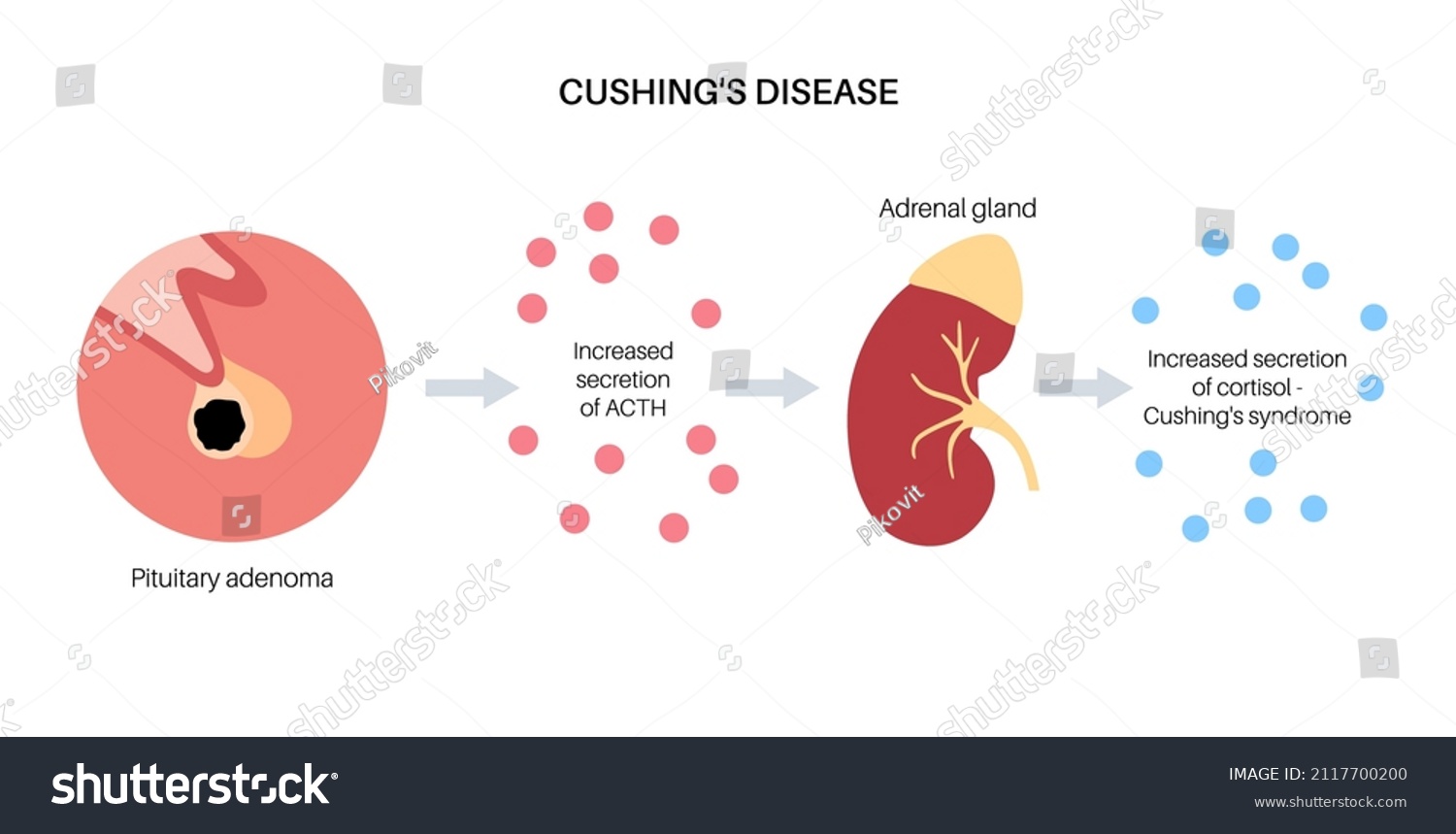 Cushing Syndrome Disease Medical Poster Pituitary Stock Vector (Royalty ...