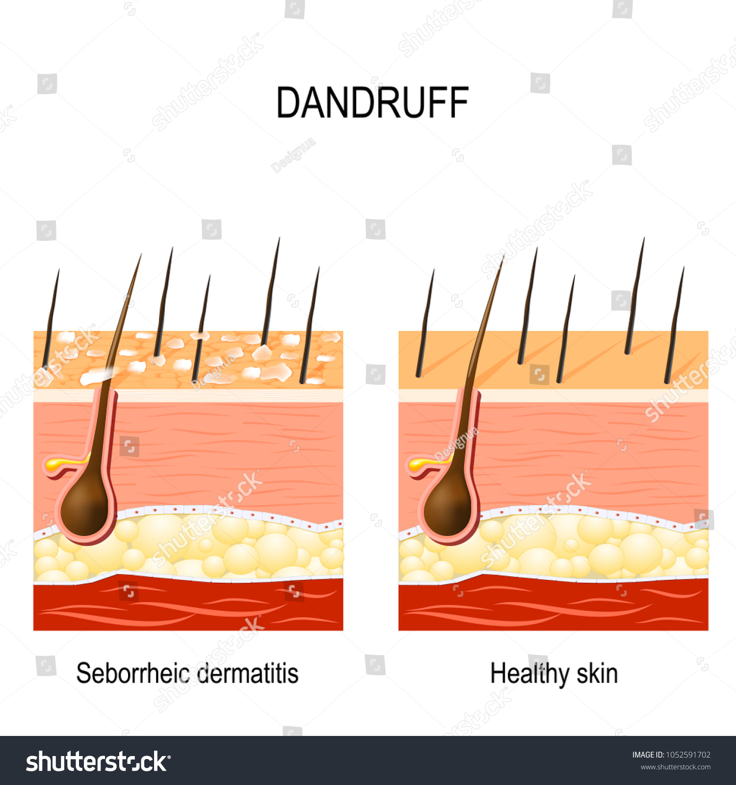 Vektor Stok Dandruff Seborrheic Dermatitis Can Occur Due Tanpa Royalti