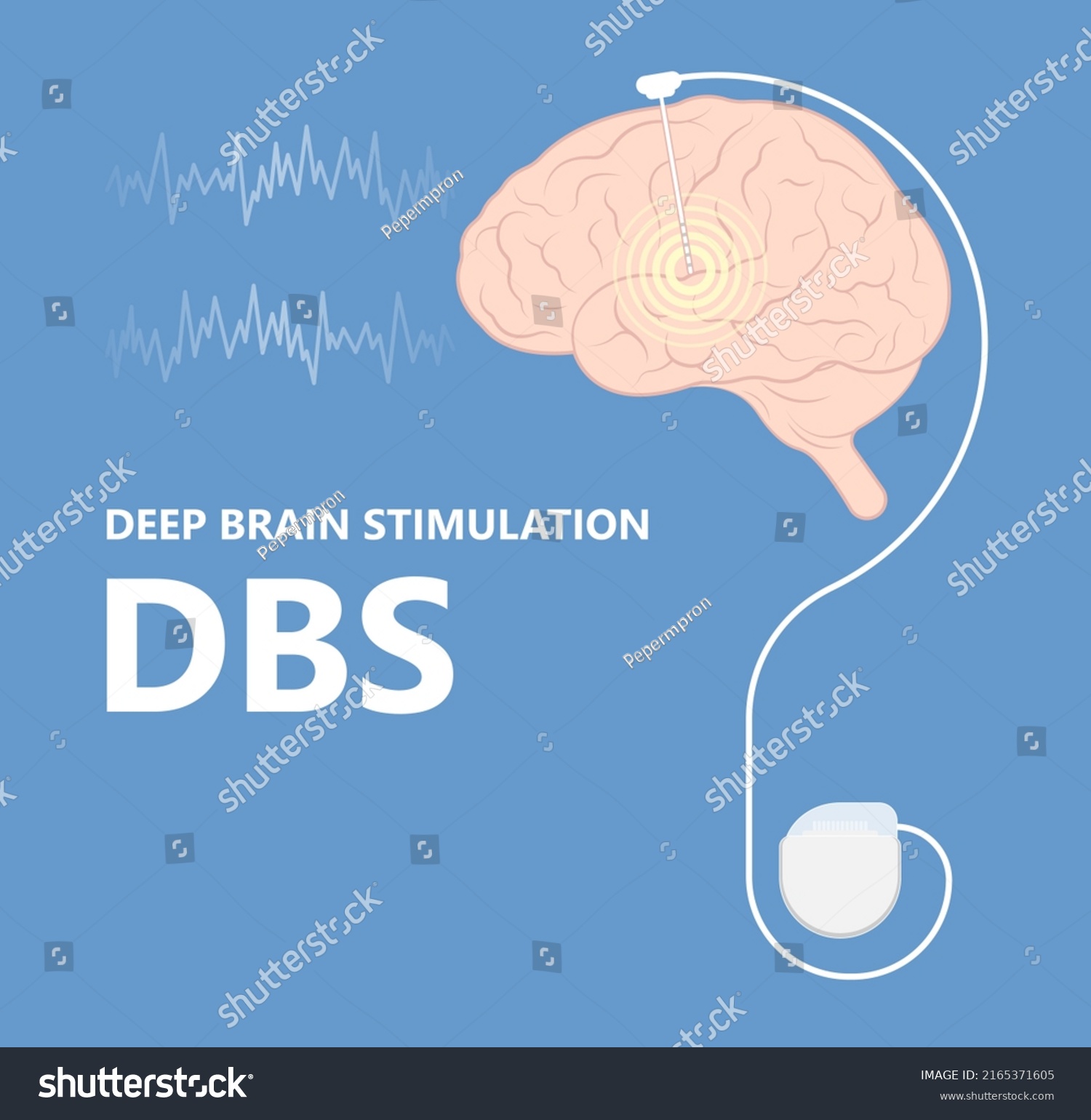 Deep Brain Stimulation Dbs Treat Parkinsons Stock Vector Royalty Free 2165371605 Shutterstock Deep Brain Stimulation Dbs Treat Parkinsons Stock Vector Royalty Free 2165371605 Shutterstock
