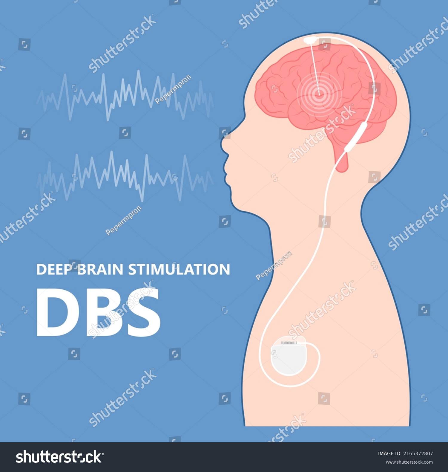 Deep Brain Stimulation Dbs Treat Parkinsons Stock Vector Royalty Free 2165372807 Shutterstock Deep Brain Stimulation Dbs Treat Parkinsons Stock Vector Royalty Free 2165372807 Shutterstock