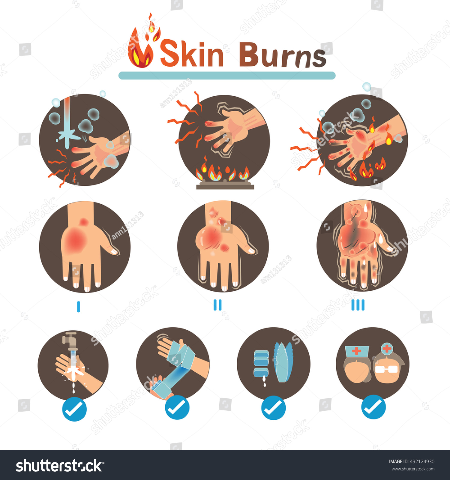 Degree Burns Thermal Burns Treatmentvector Illustrations Stock Vector ...