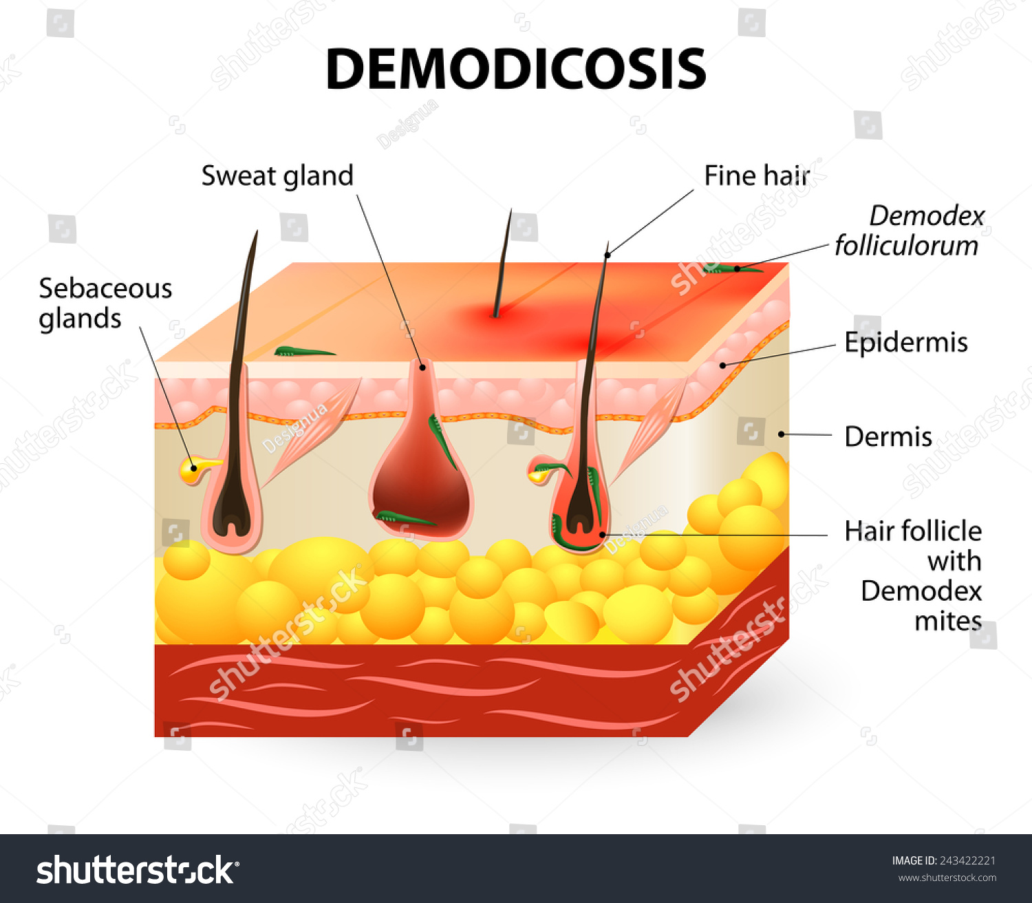 Disease description - DemodexDemodex