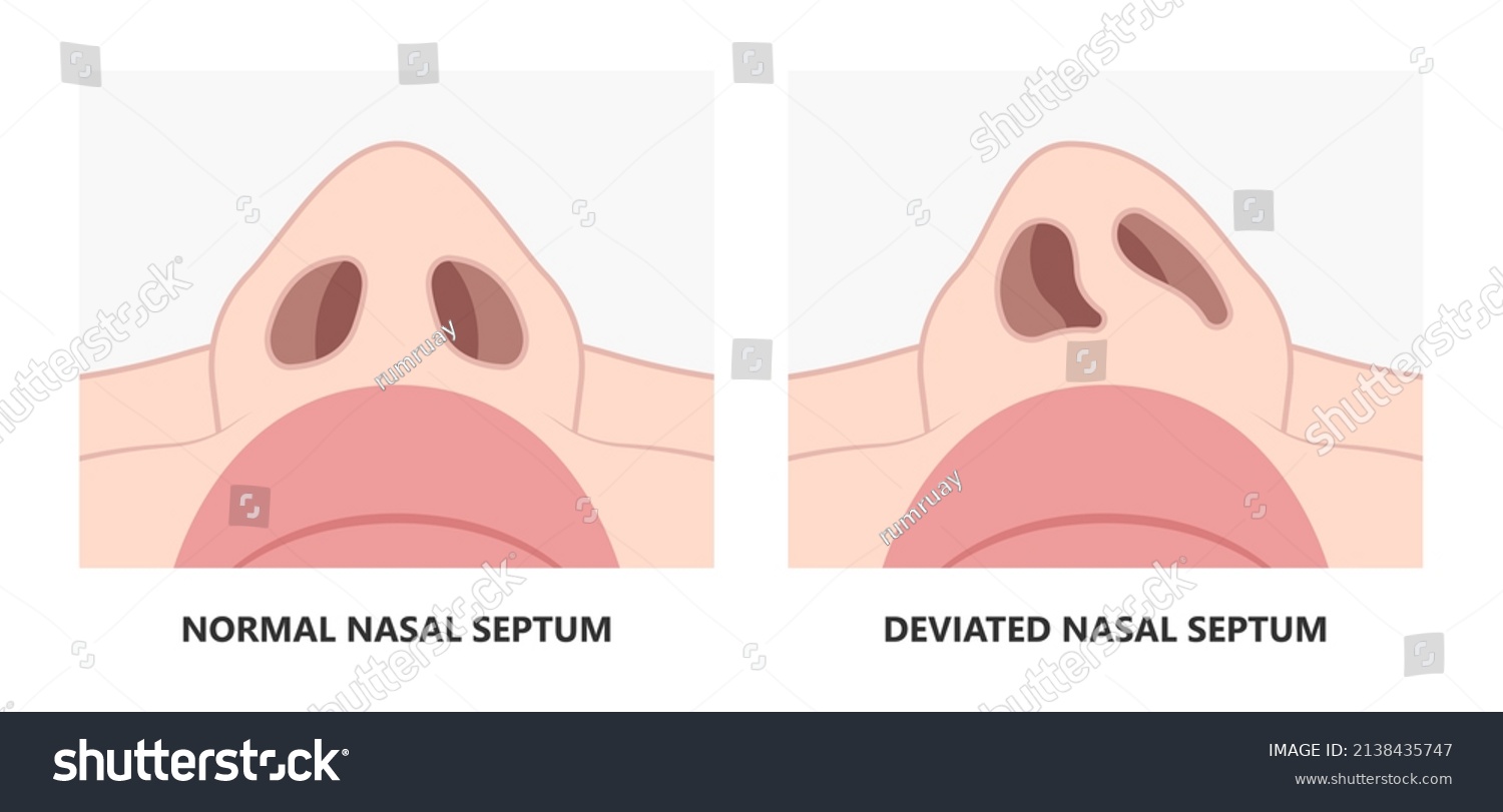 Deviated Ear Ent Cpap Nose Stop Stock Vector (Royalty Free) 2138435747 ...