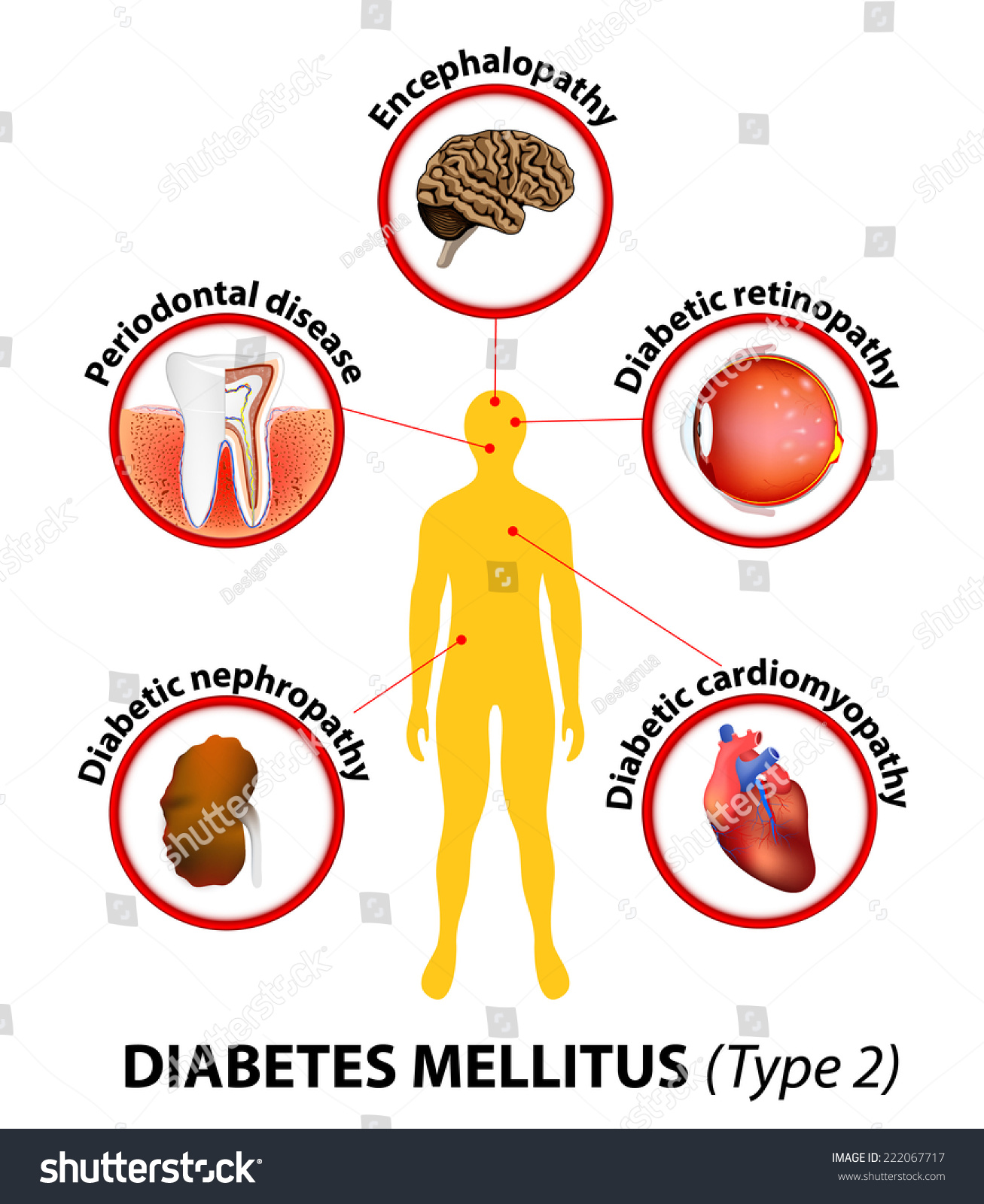 Diabetes Mellitus Type 2 Longterm Complications Stock Vector (Royalty