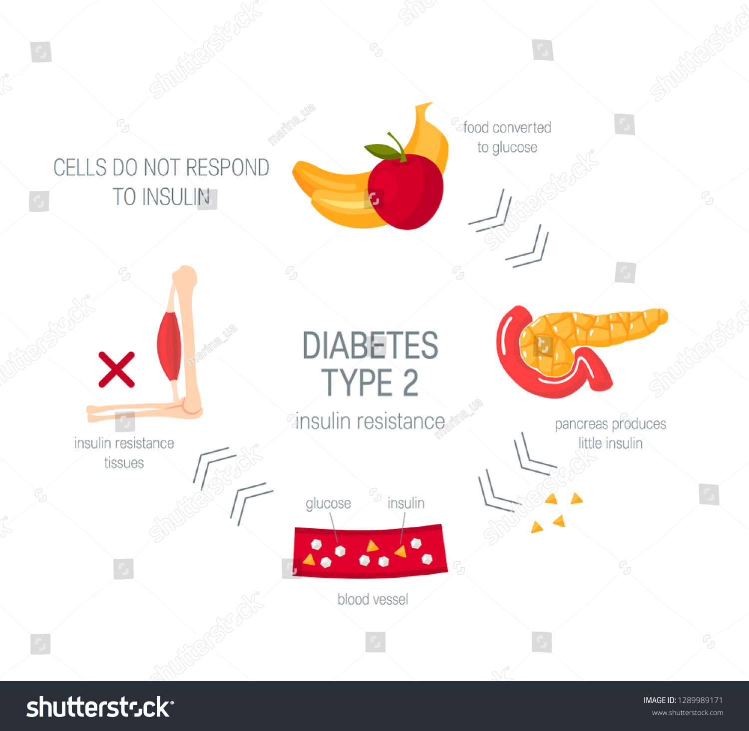 Concepto De Diabetes Tipo 2. Diagrama: Vector De Stock (libre De ...