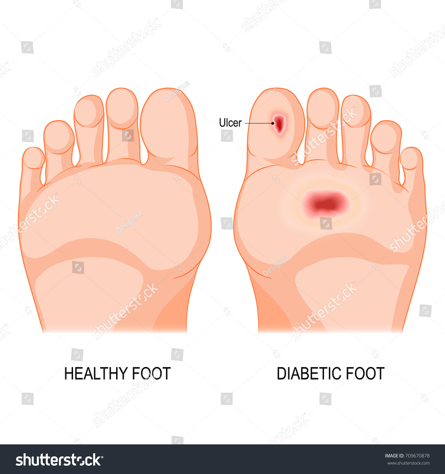 Diabetic Foot Foot Bottom Pathology 