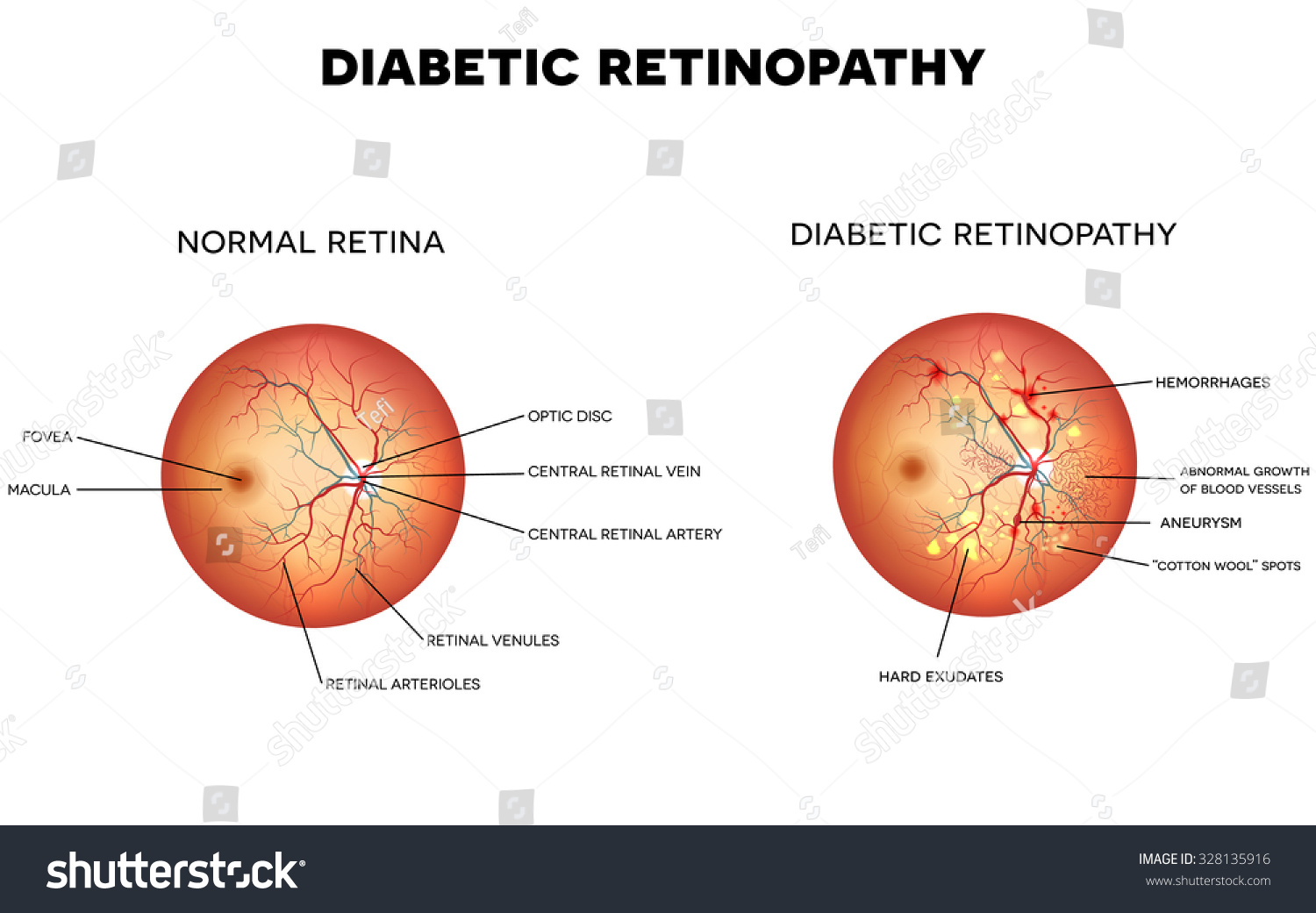 Diabetic Retinopathy And Normal Eye Retina. Stock Vector Illustration ...