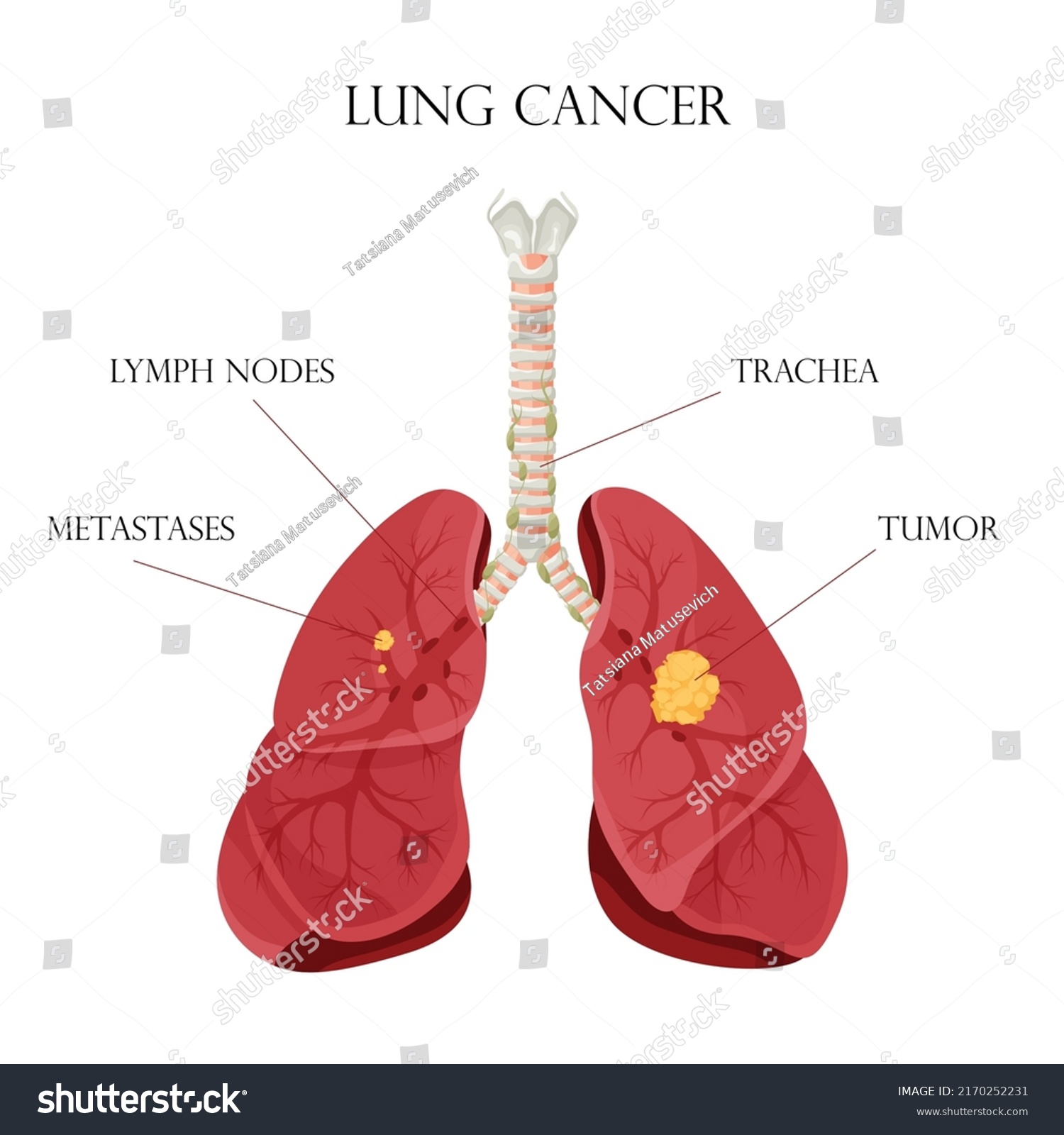 Diagram Lung Cancer Disease Concept Disease Stock Vector (Royalty Free ...